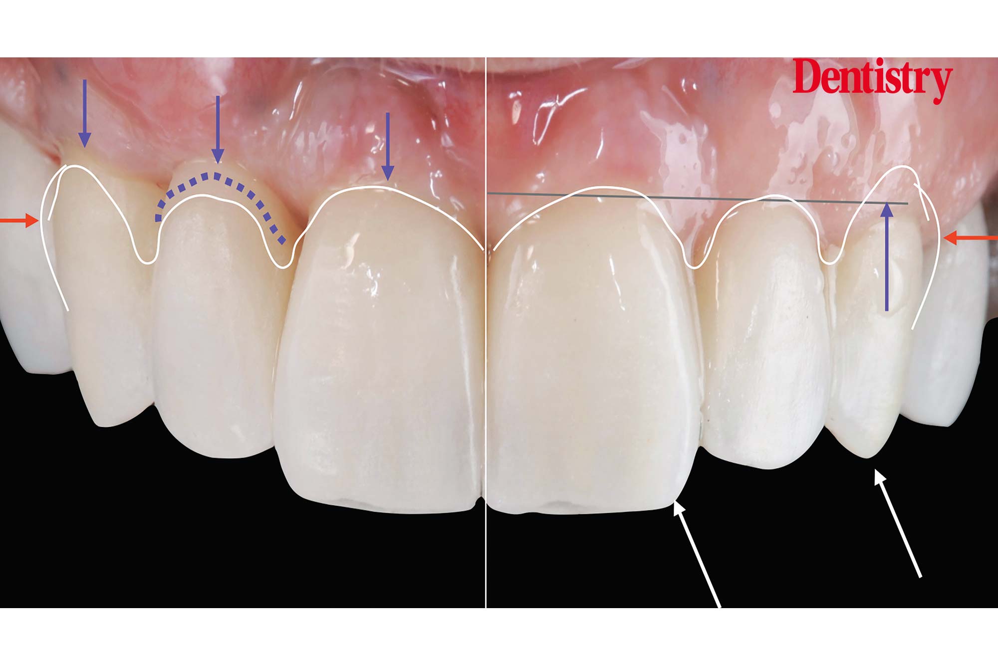 Digital workflow: a game changer for implant restoration