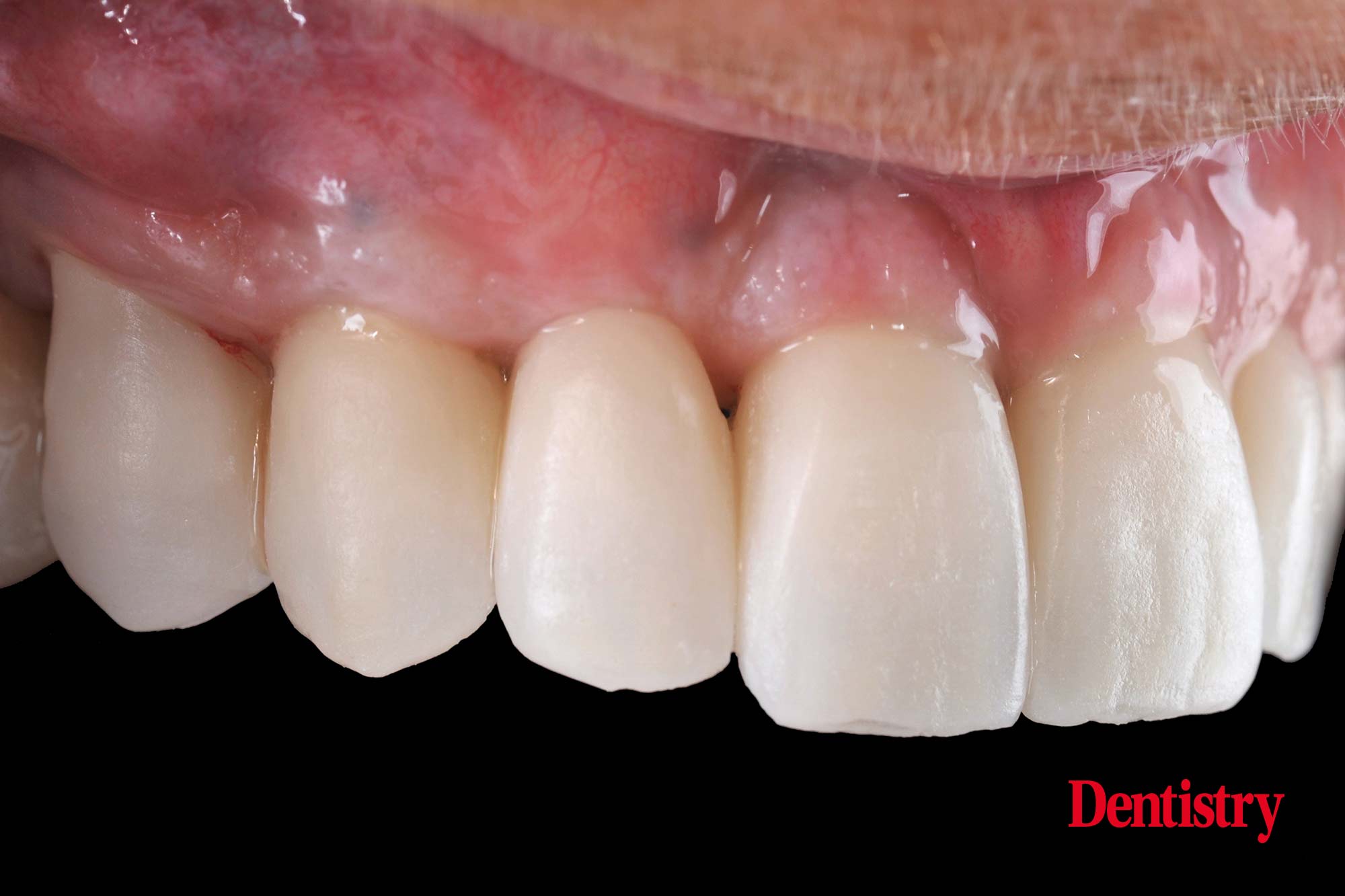 Digital workflow: a game changer for implant restoration