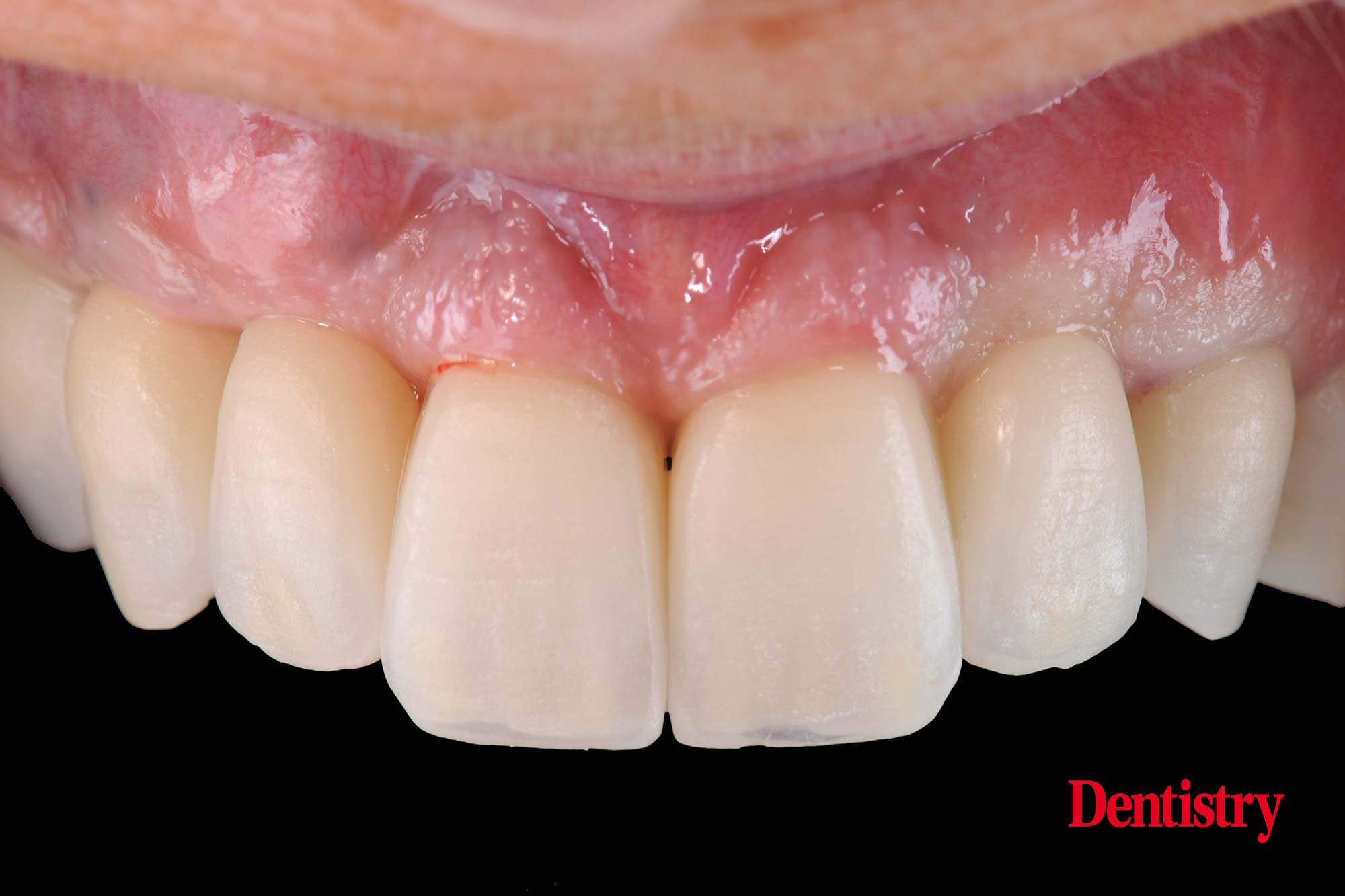 Digital workflow: a game changer for implant restoration