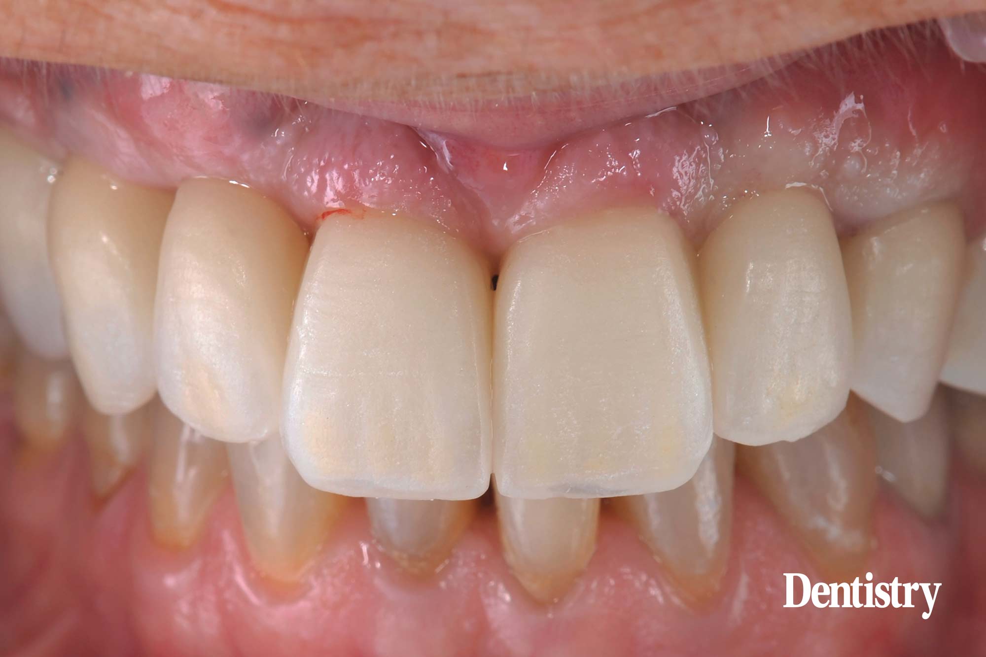 Digital workflow: a game changer for implant restoration