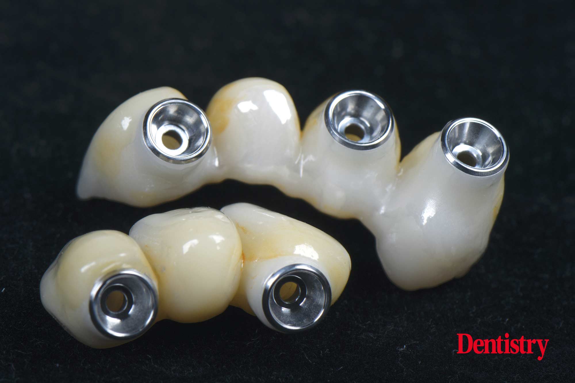 Digital workflow: a game changer for implant restoration