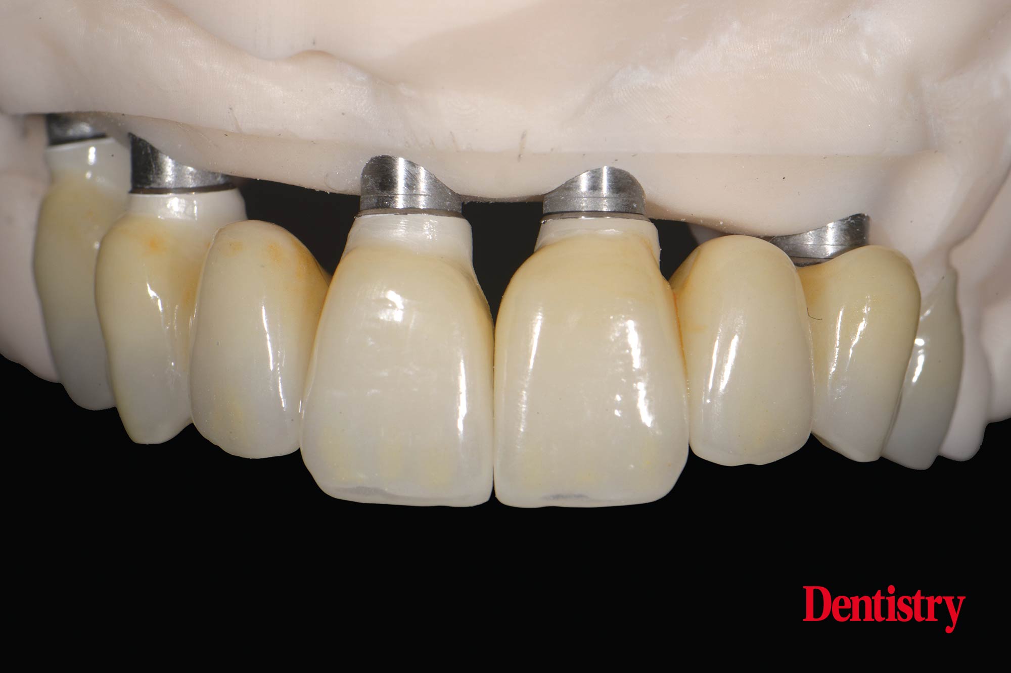 Digital workflow: a game changer for implant restoration