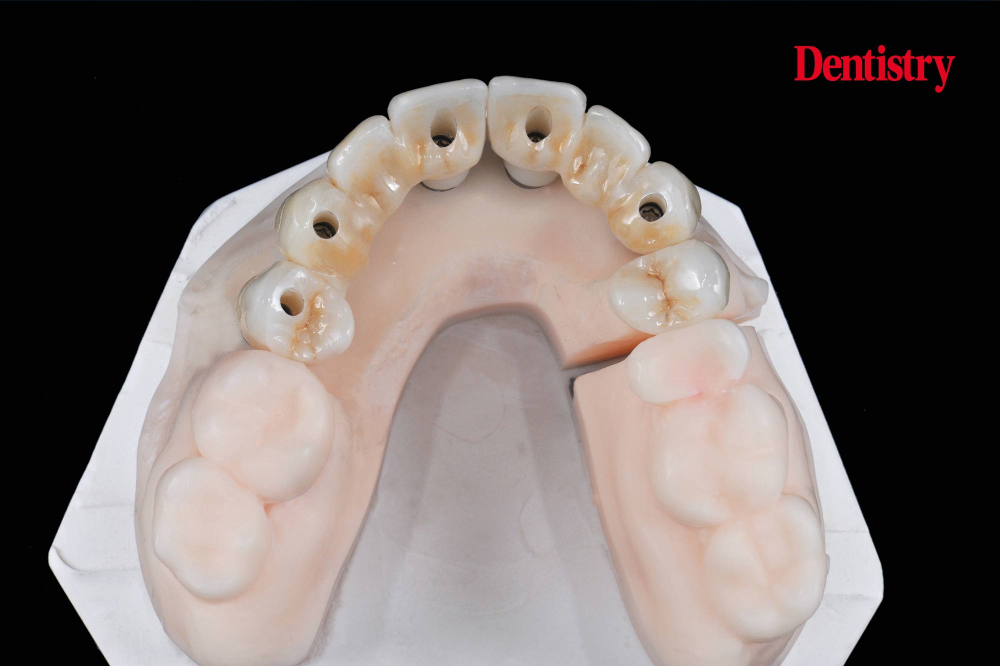 Digital workflow: a game changer for implant restoration