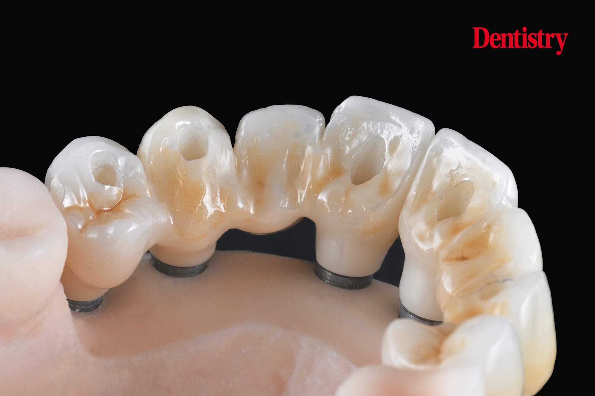 Digital workflow: a game changer for implant restoration