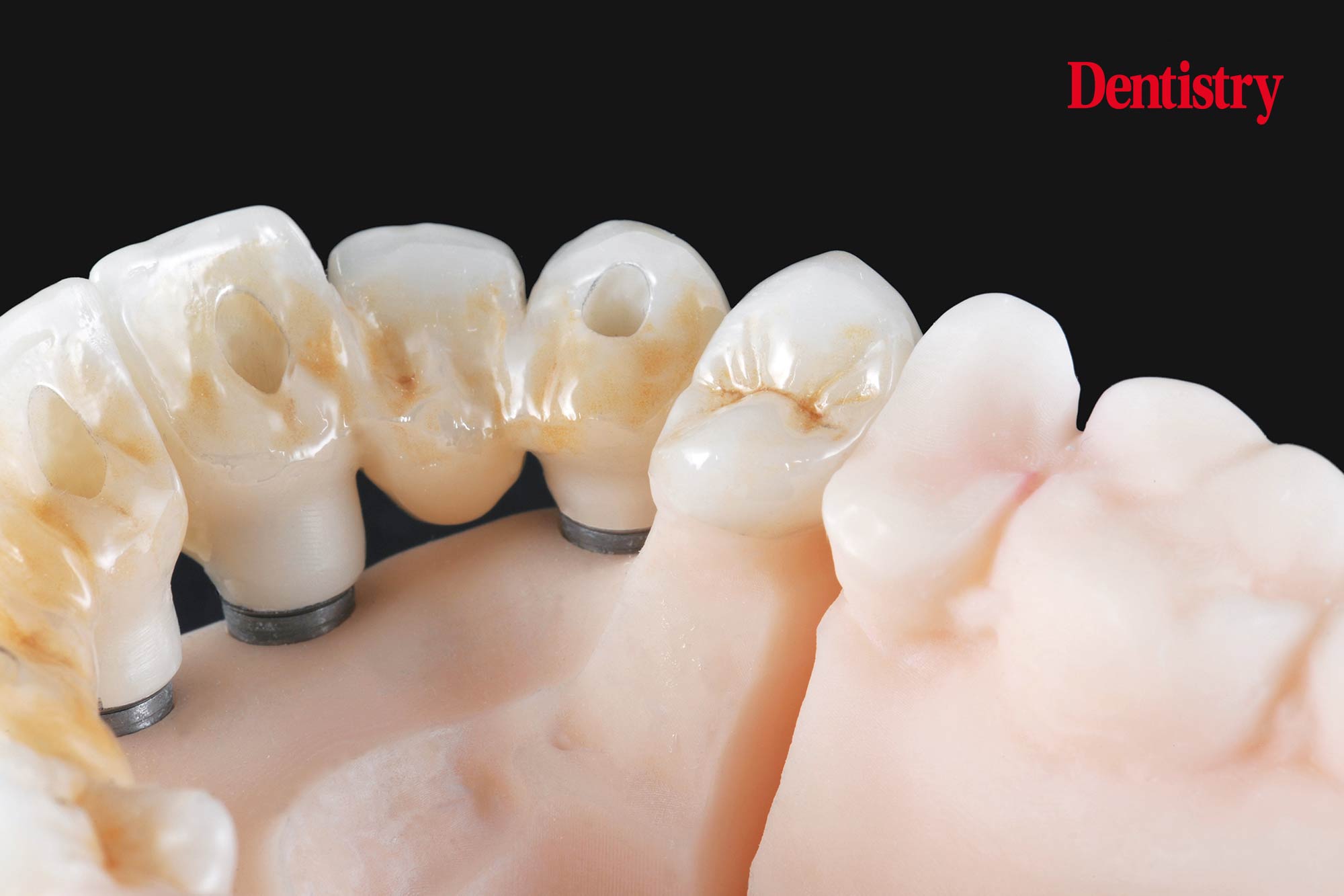 Digital workflow: a game changer for implant restoration