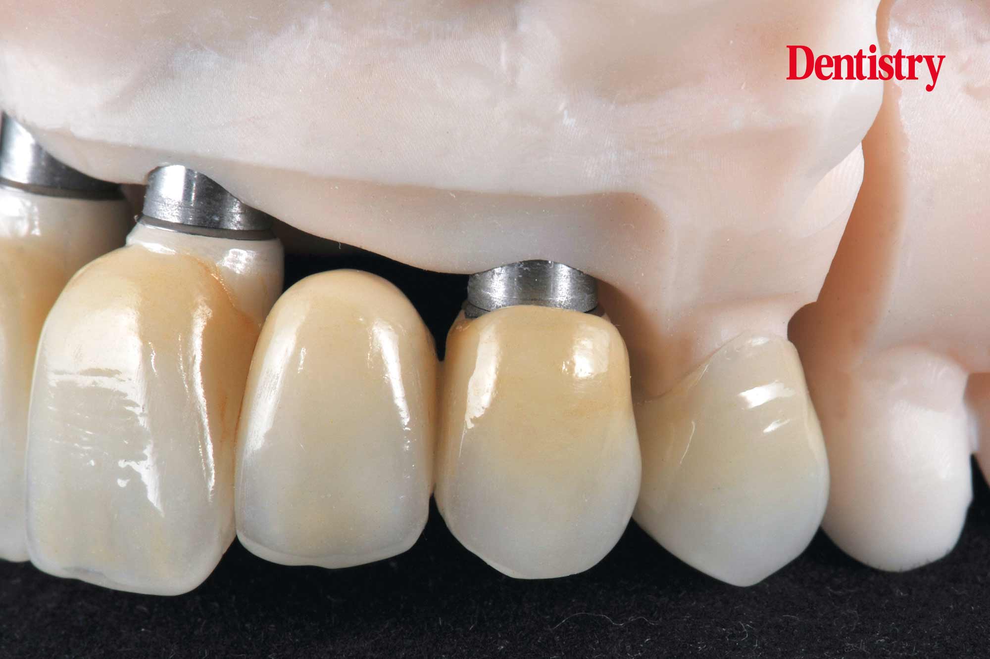 Digital workflow: a game changer for implant restoration