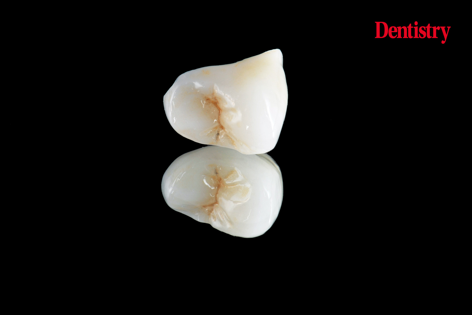 Digital workflow: a game changer for implant restoration