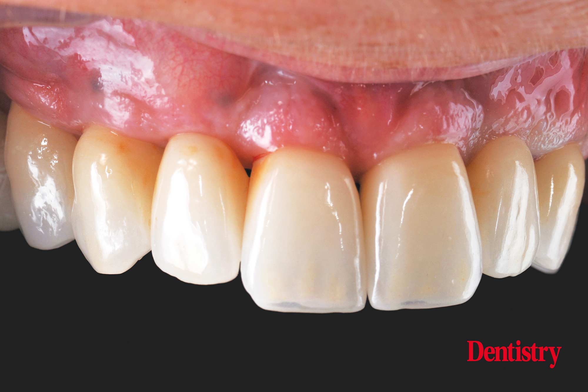 Digital workflow: a game changer for implant restoration