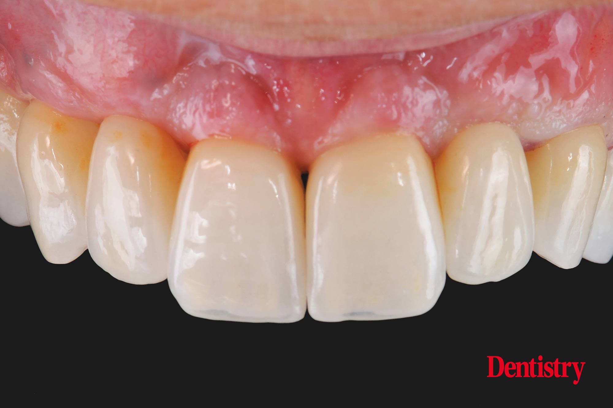 Digital workflow: a game changer for implant restoration