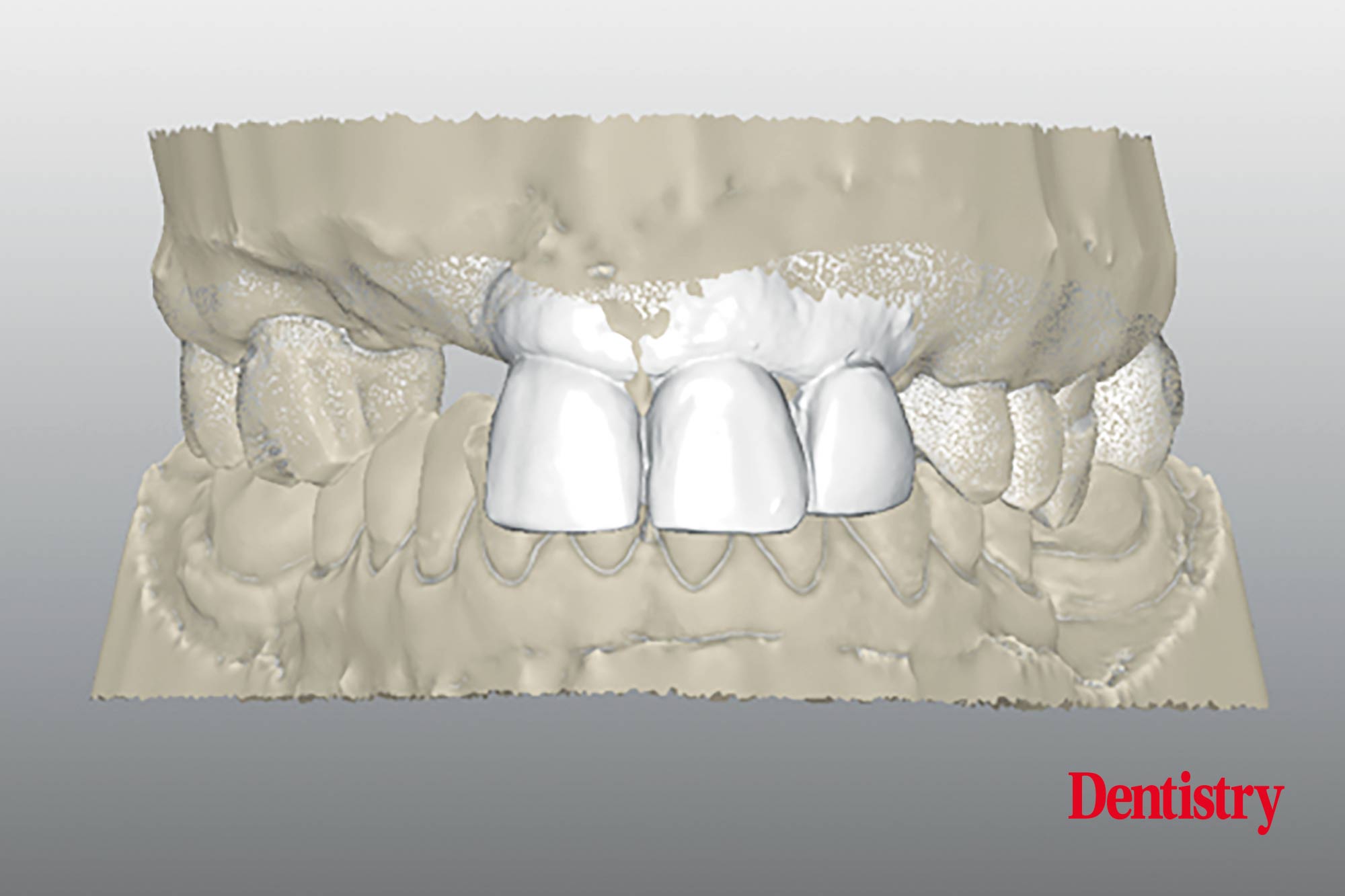 Digital workflow: a game changer for implant restoration