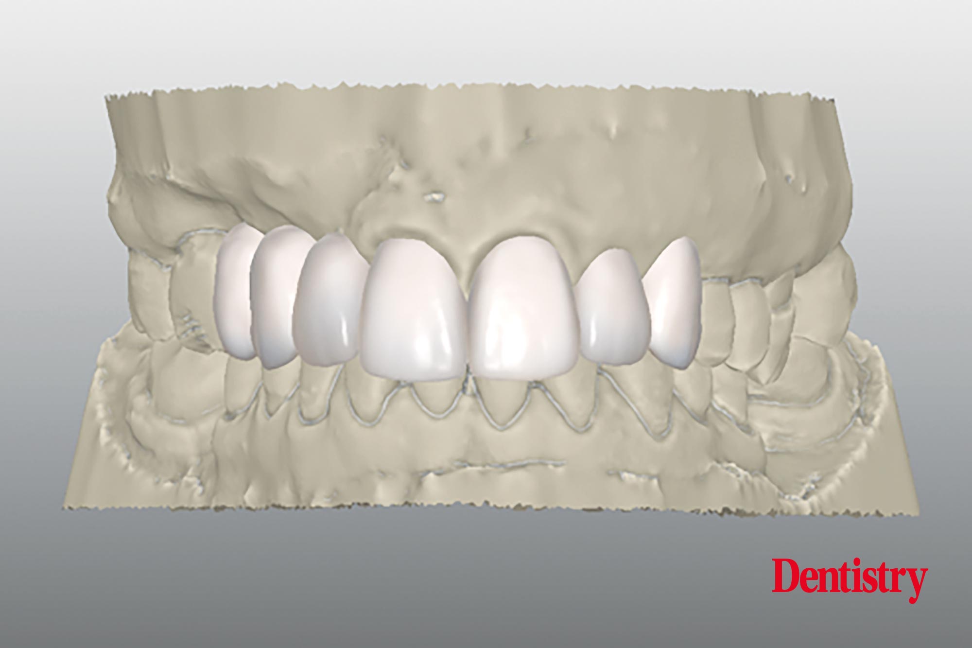 Digital workflow: a game changer for implant restoration