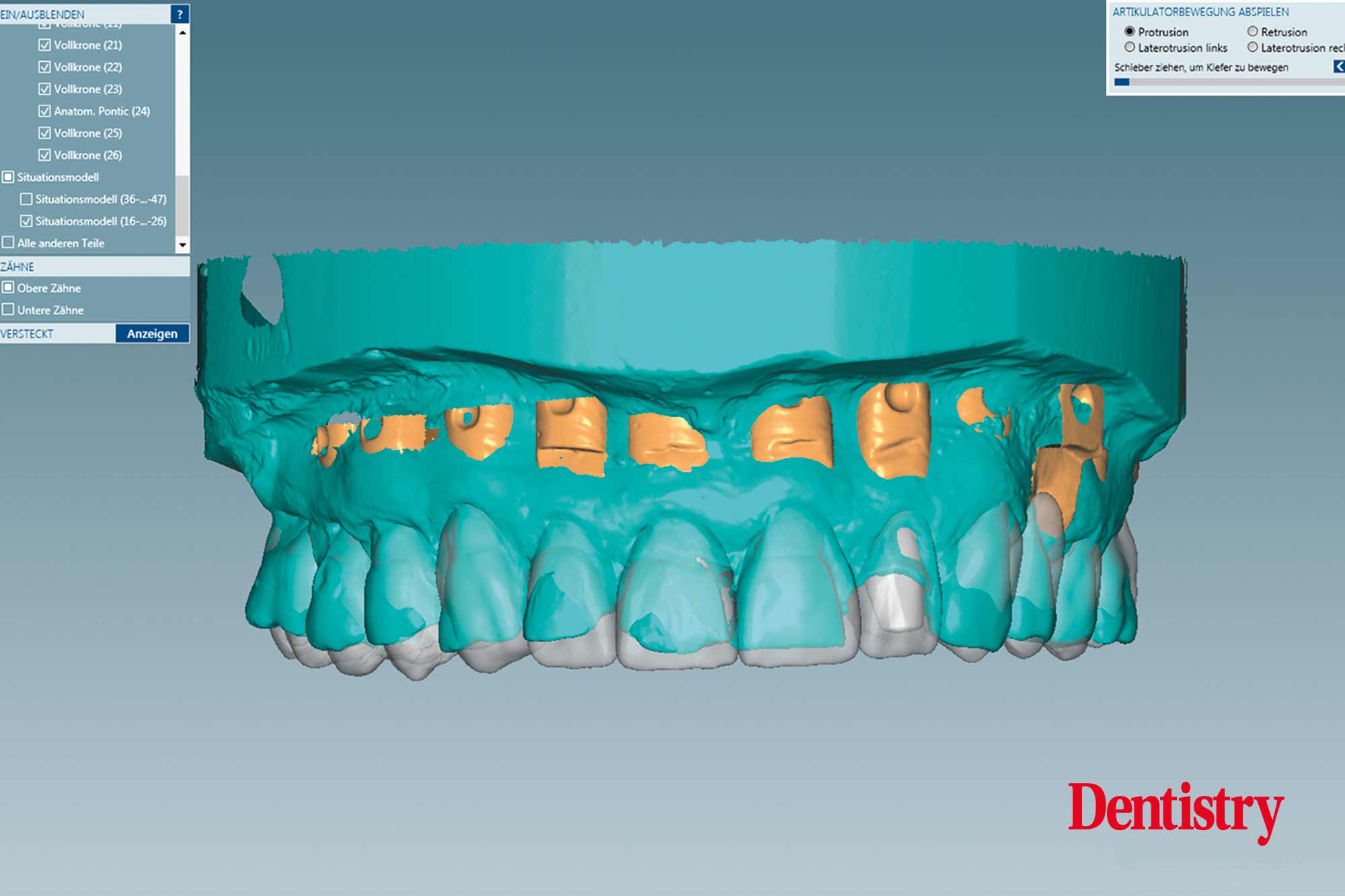 Fabrication and cementation of crowns without chipping