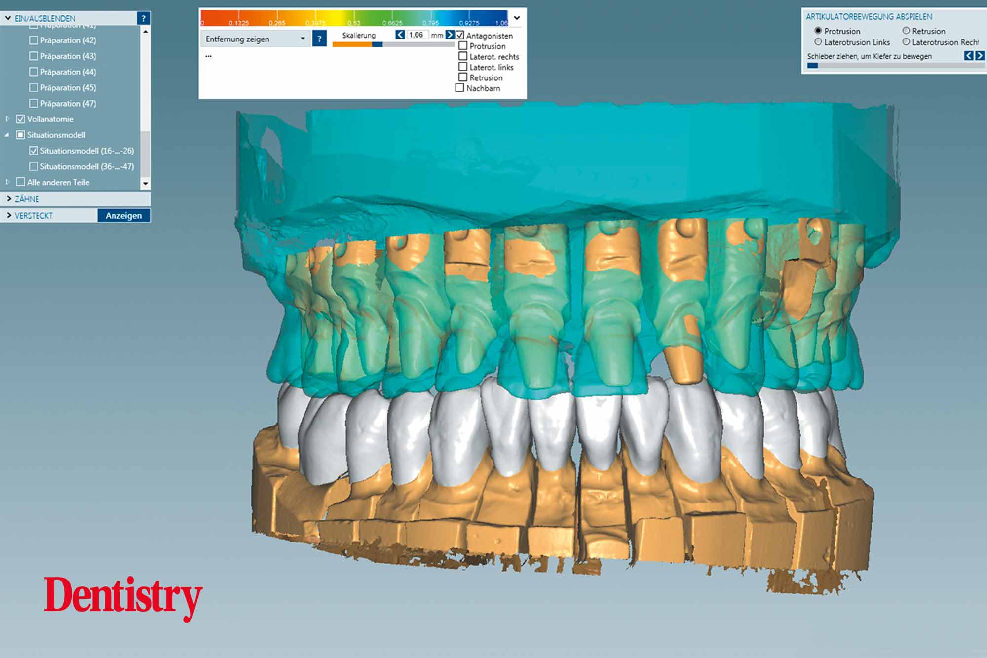 Fabrication and cementation of crowns without chipping