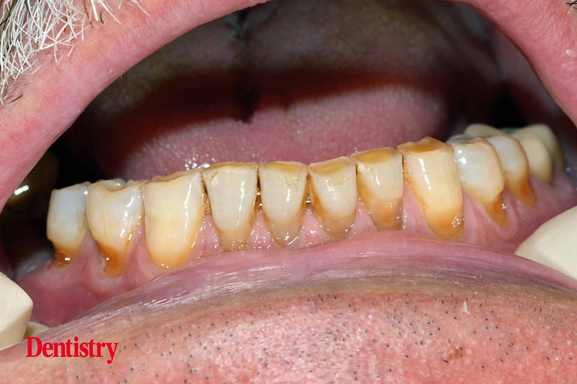Fabrication and cementation of crowns without chipping