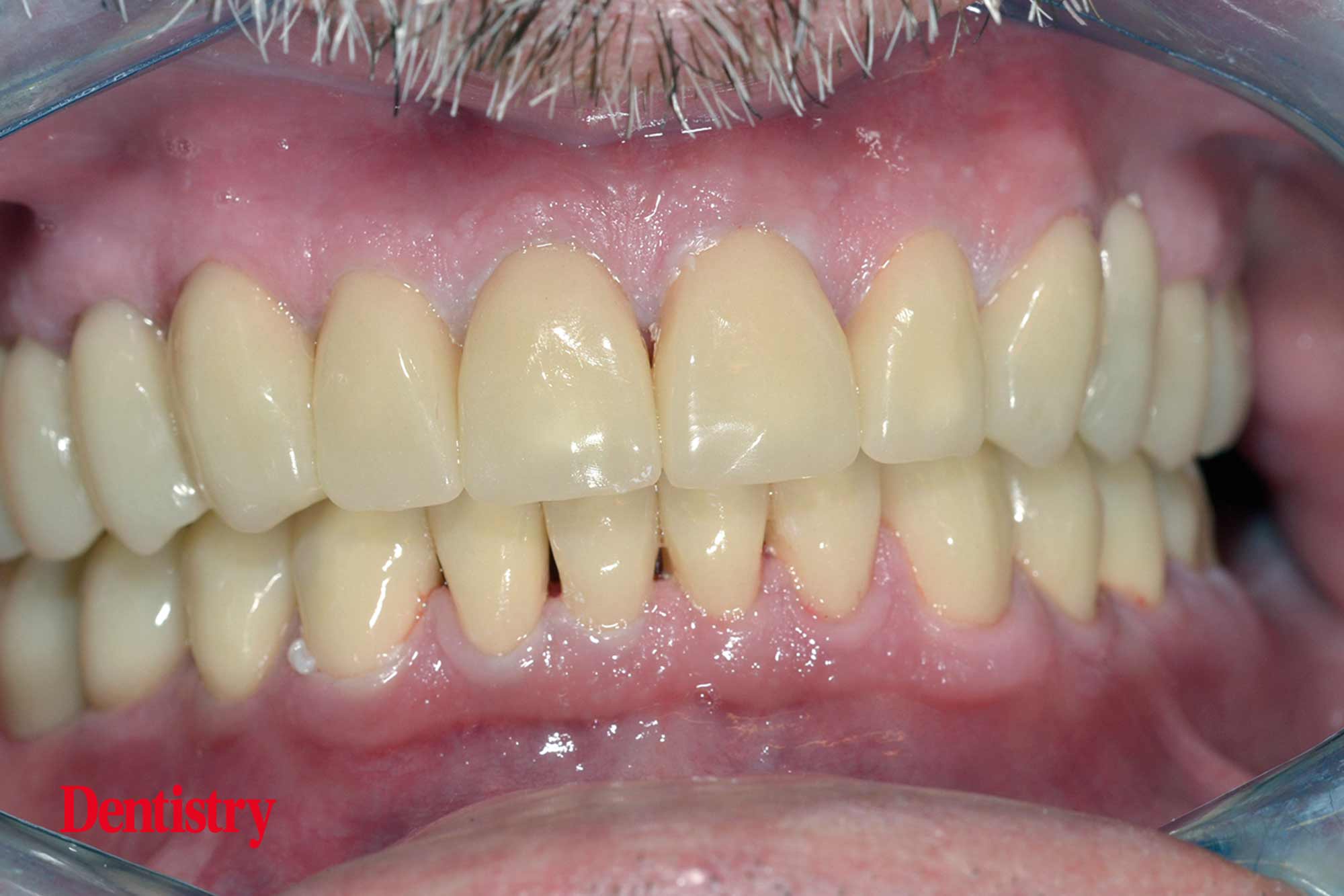 Fabrication and cementation of crowns without chipping