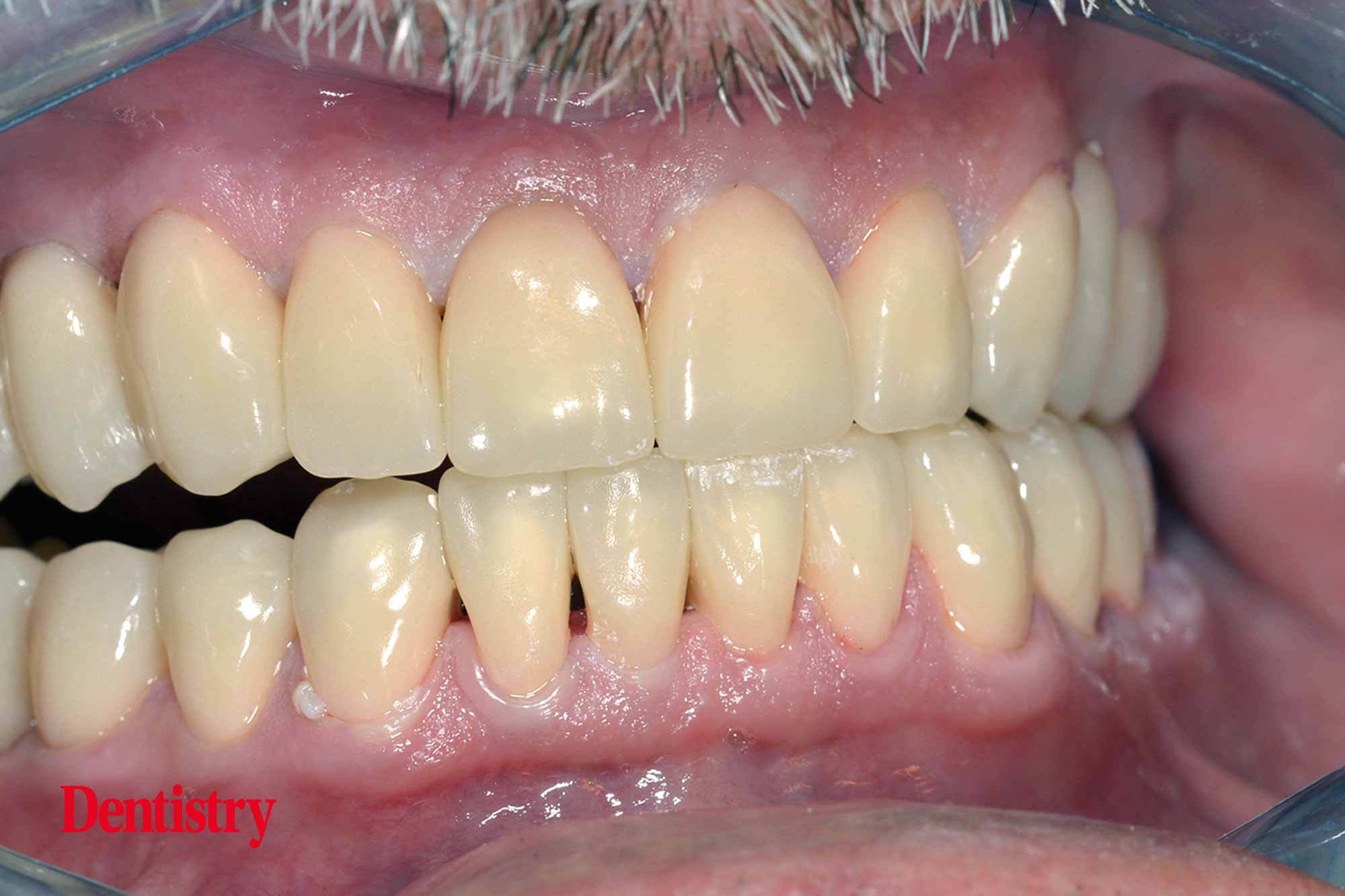 Fabrication and cementation of crowns without chipping