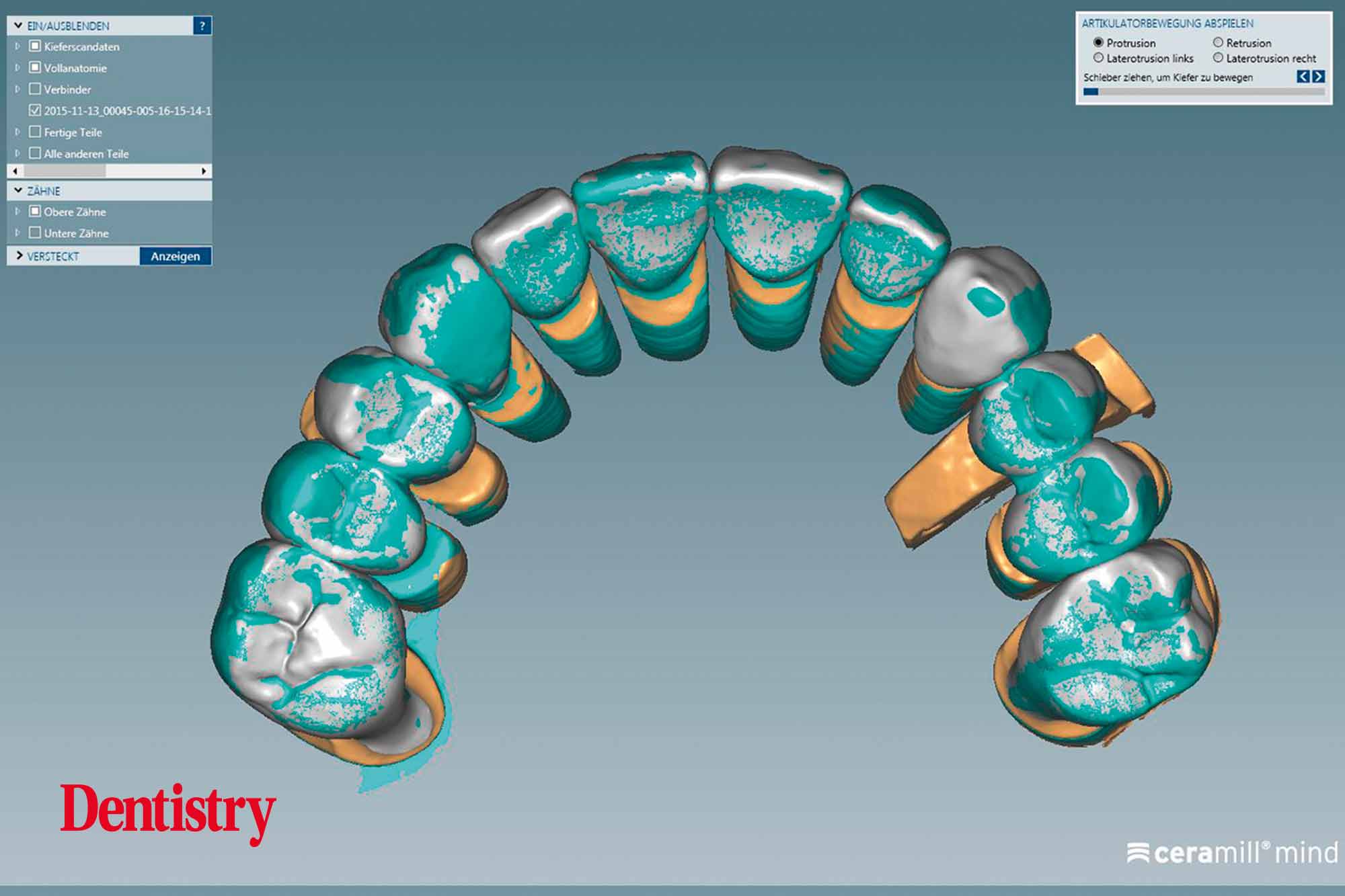 Fabrication and cementation of crowns without chipping