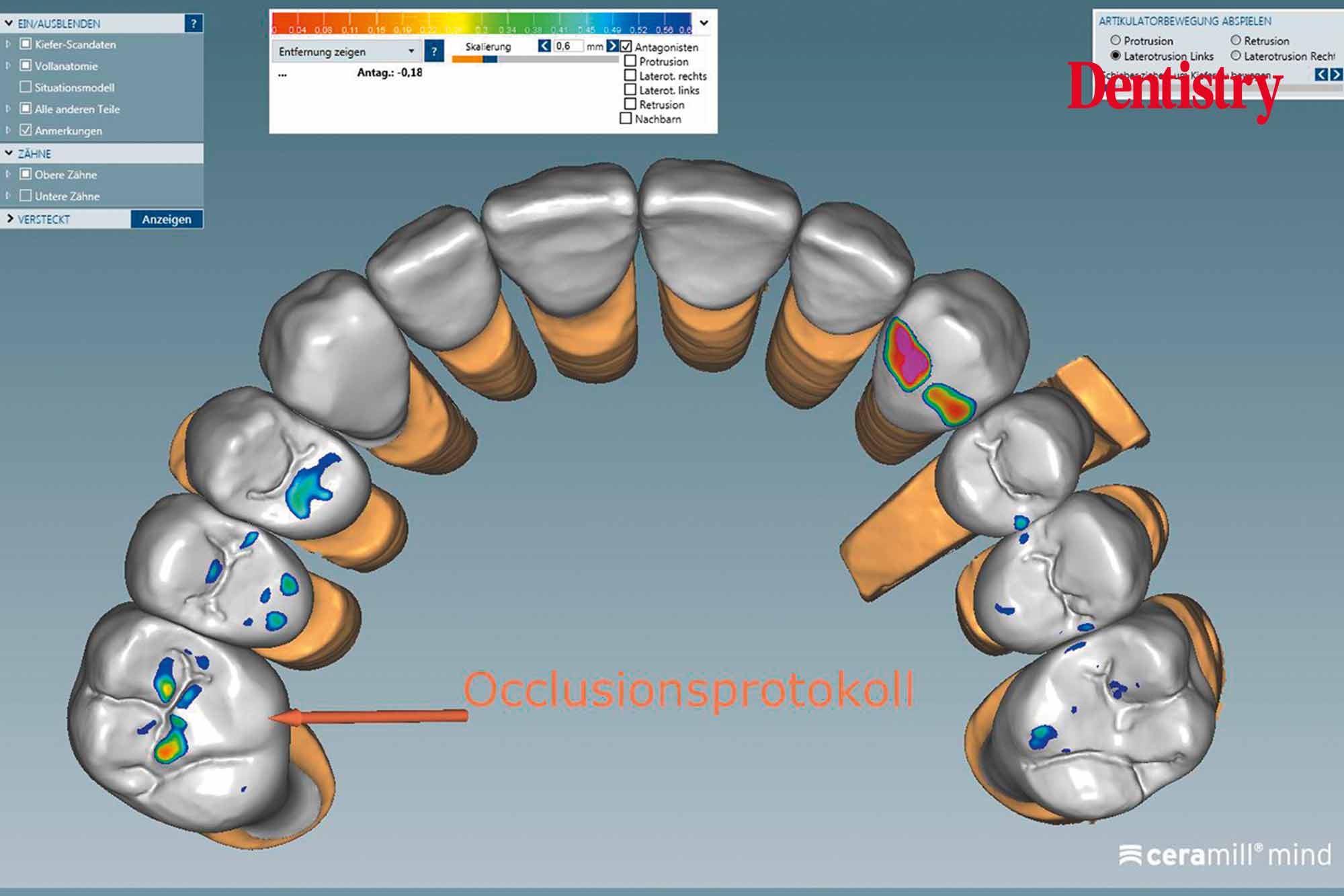 Fabrication and cementation of crowns without chipping