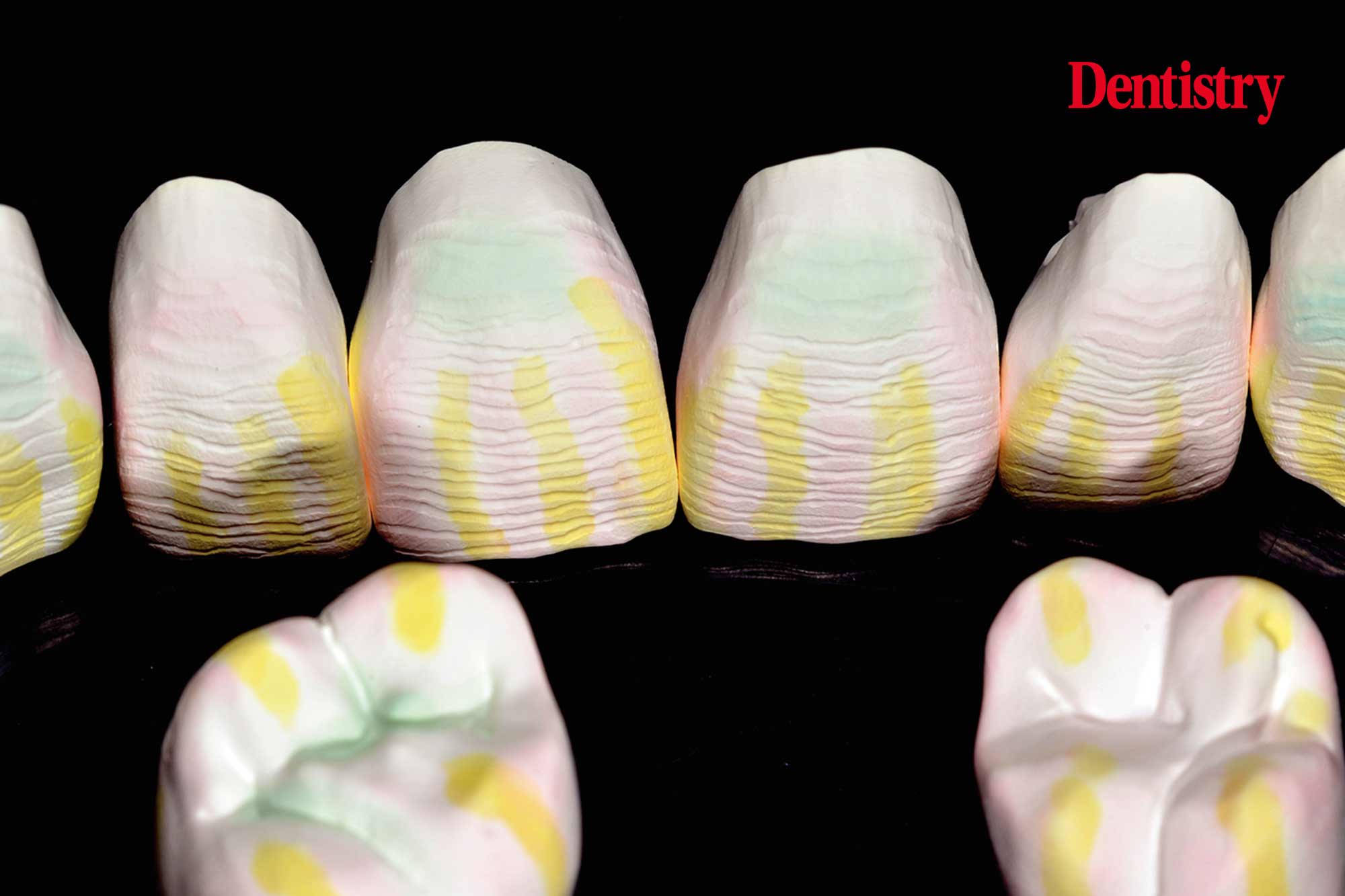 Fabrication and cementation of crowns without chipping