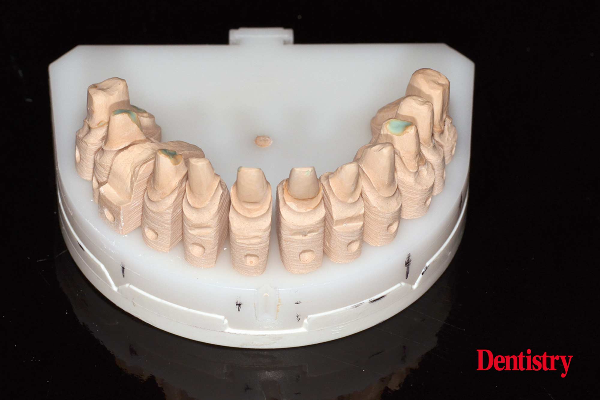 Fabrication and cementation of crowns without chipping