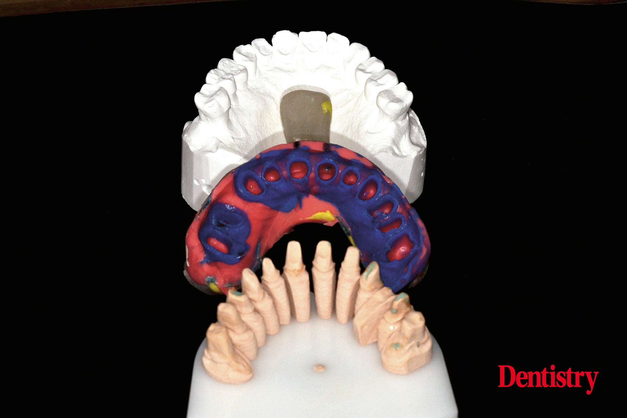 Fabrication and cementation of crowns without chipping