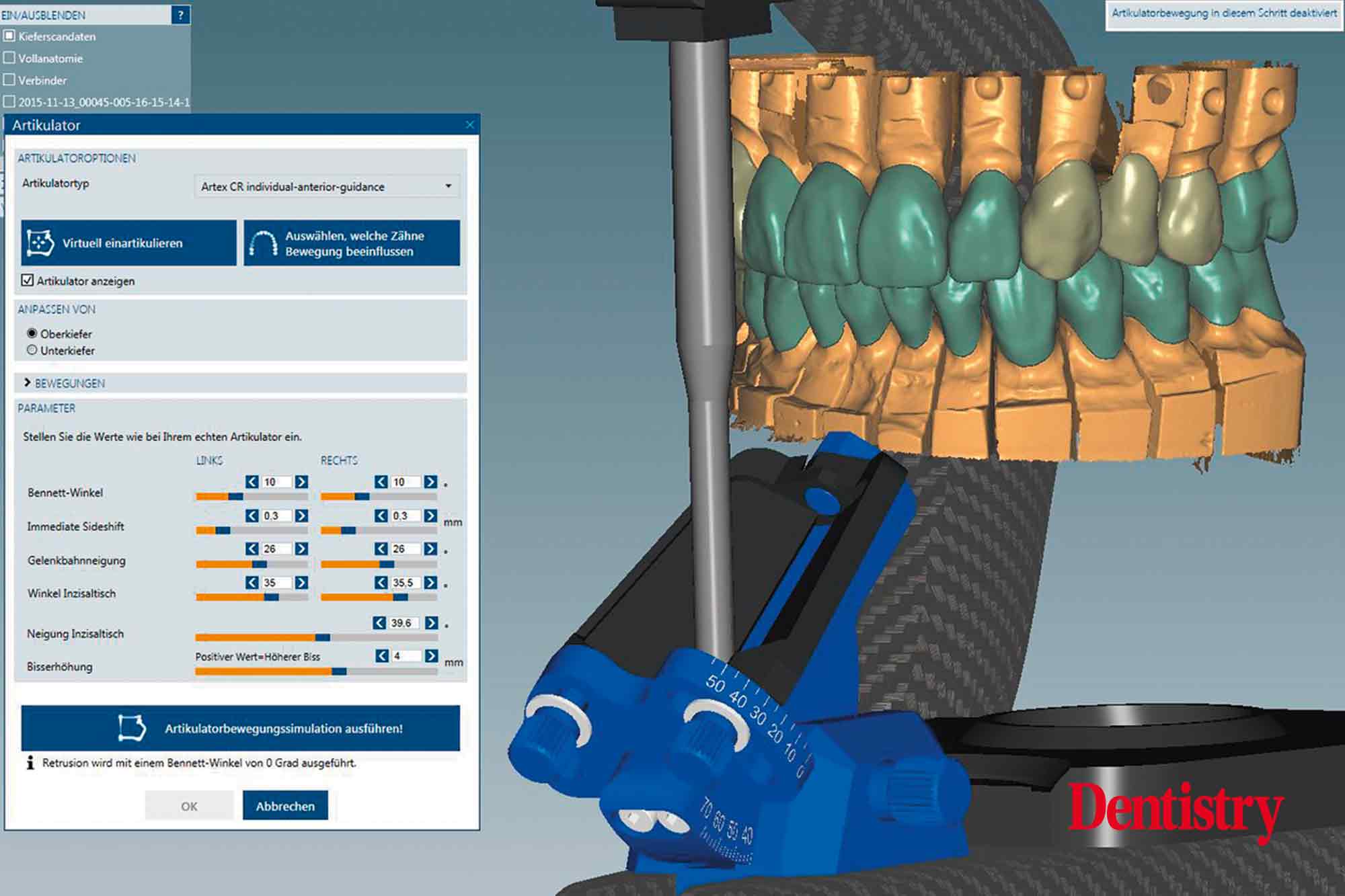 Fabrication and cementation of crowns without chipping