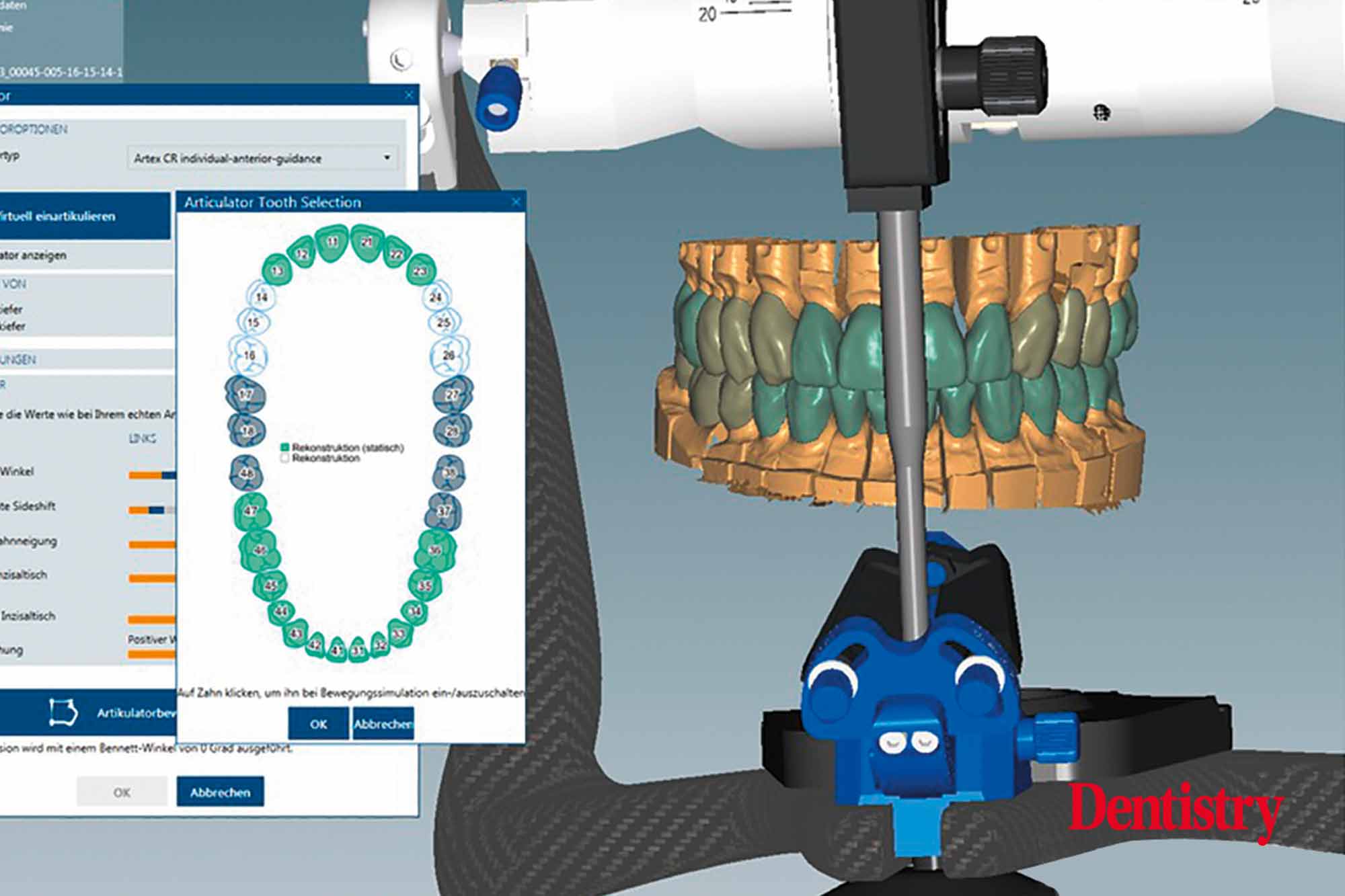 Fabrication and cementation of crowns without chipping