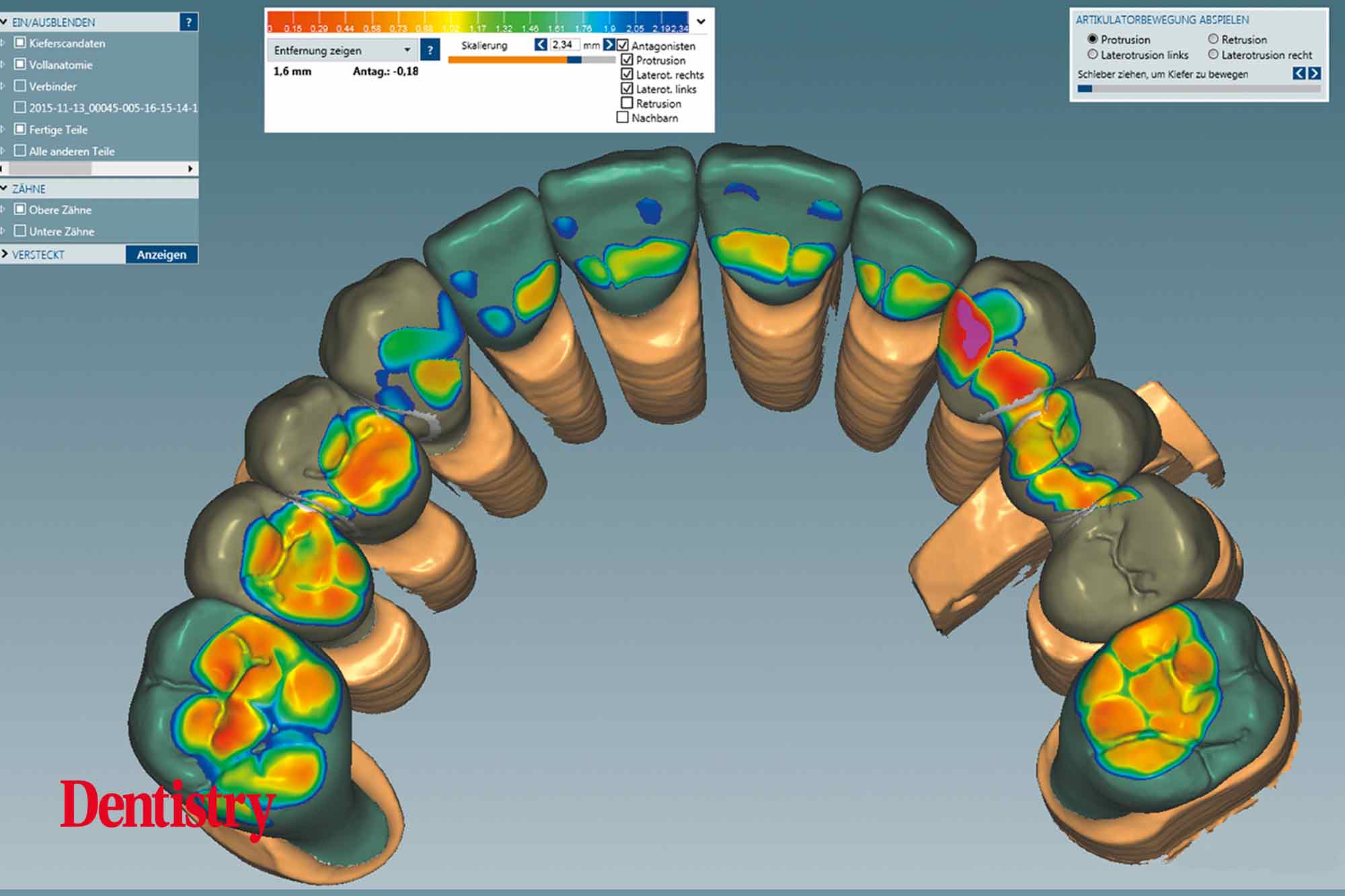 Fabrication and cementation of crowns without chipping