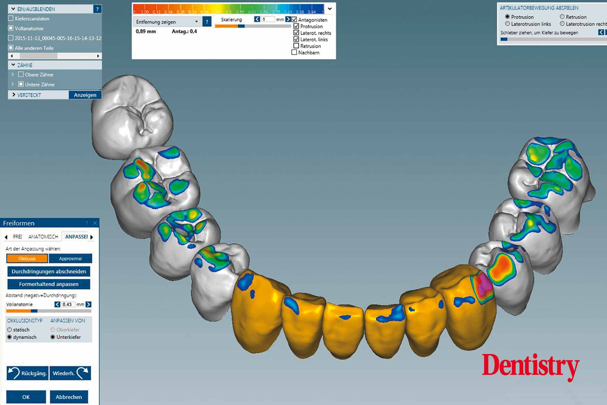 Fabrication and cementation of crowns without chipping
