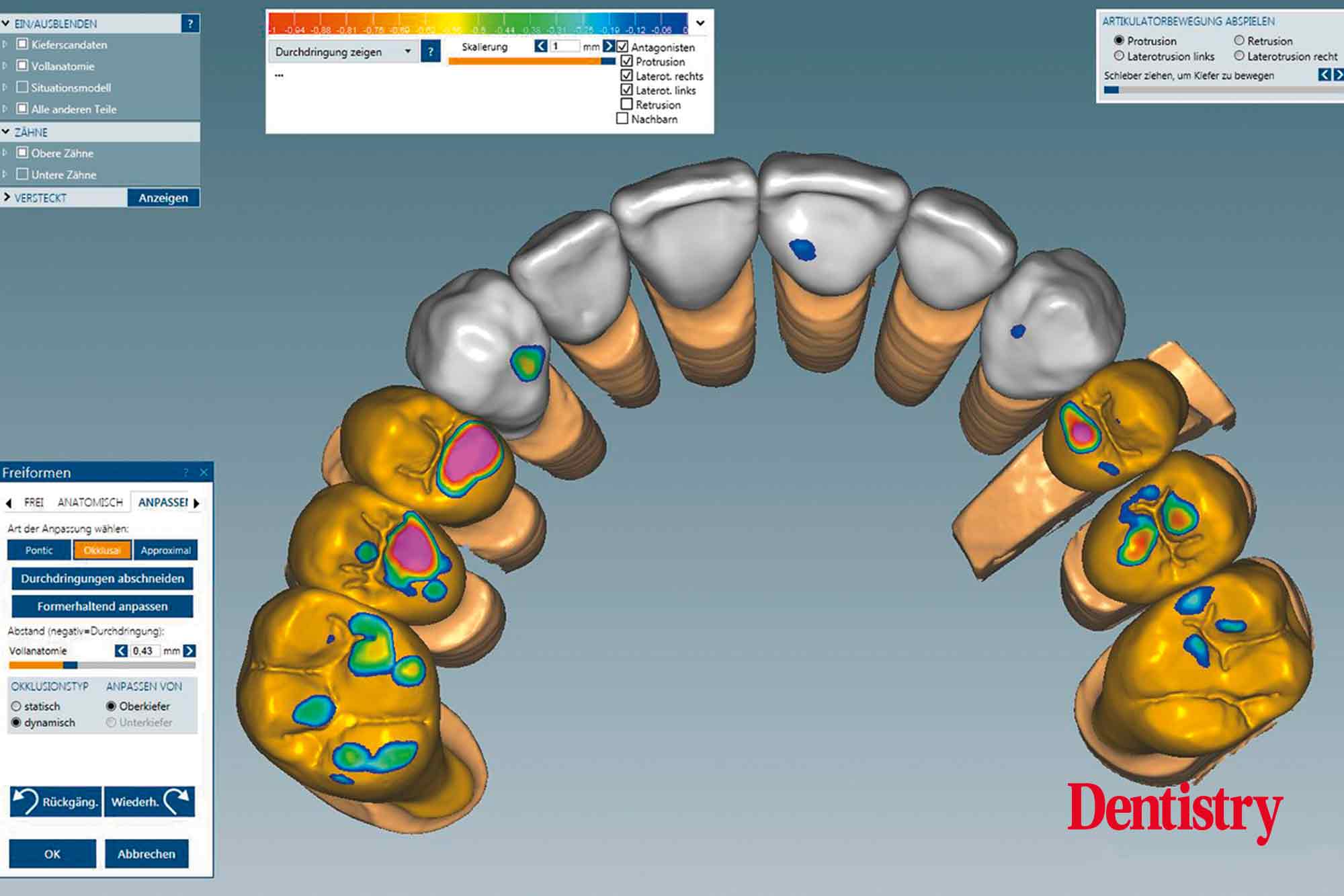 Fabrication and cementation of crowns without chipping