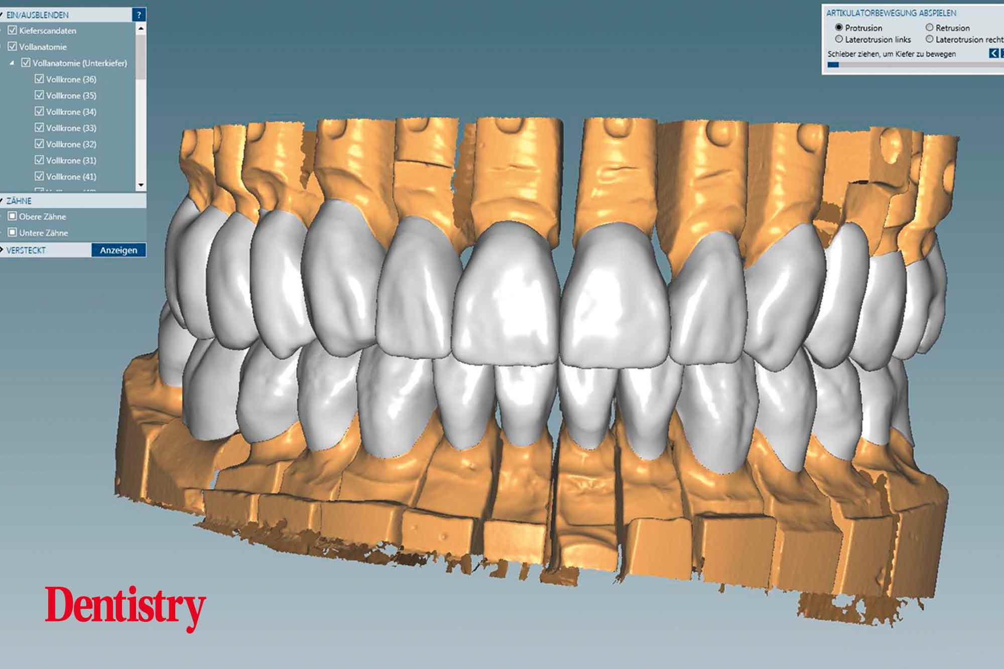 Fabrication and cementation of crowns without chipping