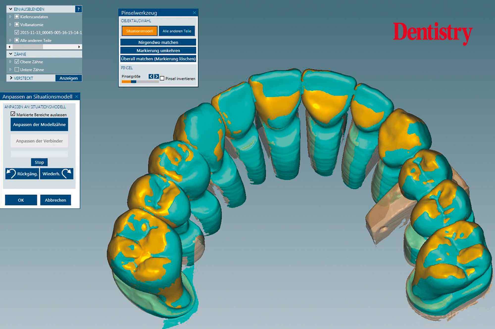 Fabrication and cementation of crowns without chipping