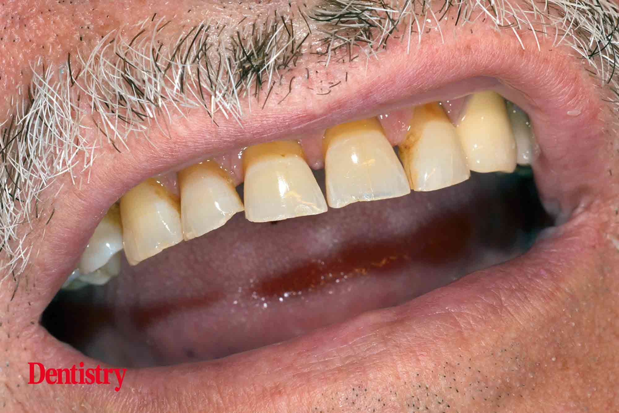 Fabrication and cementation of crowns without chipping