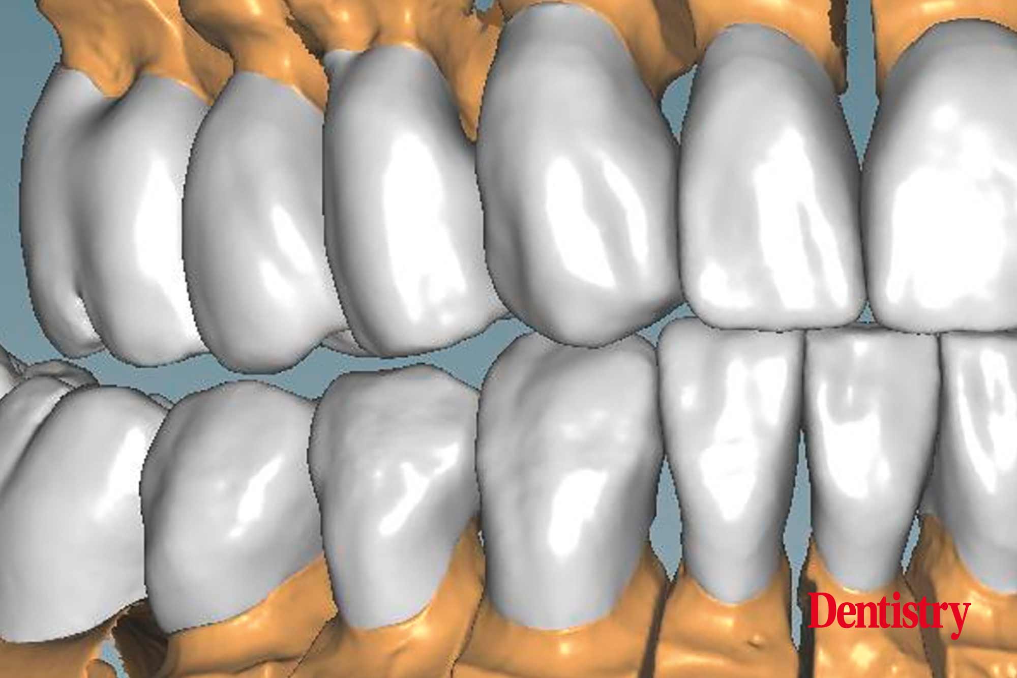 Fabrication and cementation of crowns without chipping
