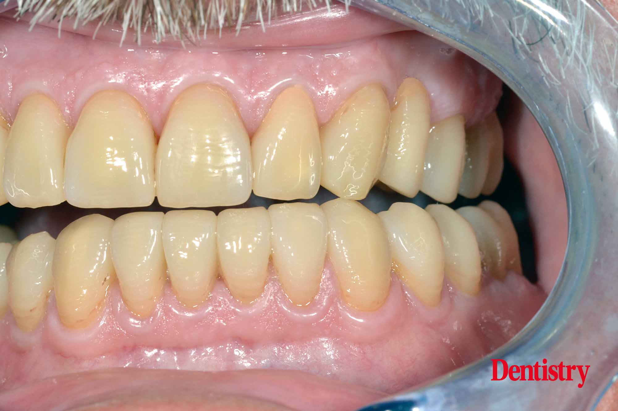 Fabrication and cementation of crowns without chipping