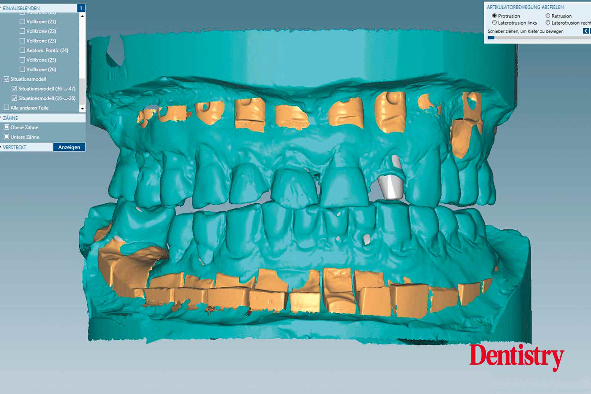 Fabrication and cementation of crowns without chipping