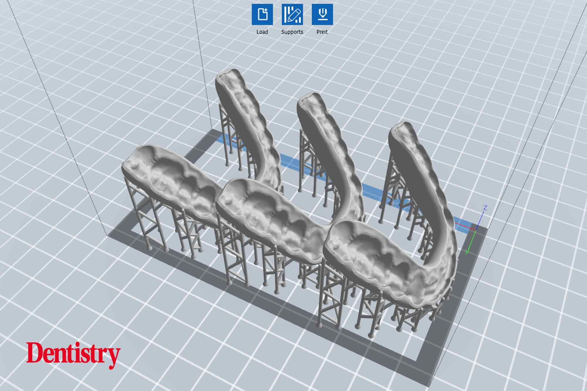 Andre Gaul RDT gives a step-by-step overview of the design and fabrication process of printed occlusal splints.