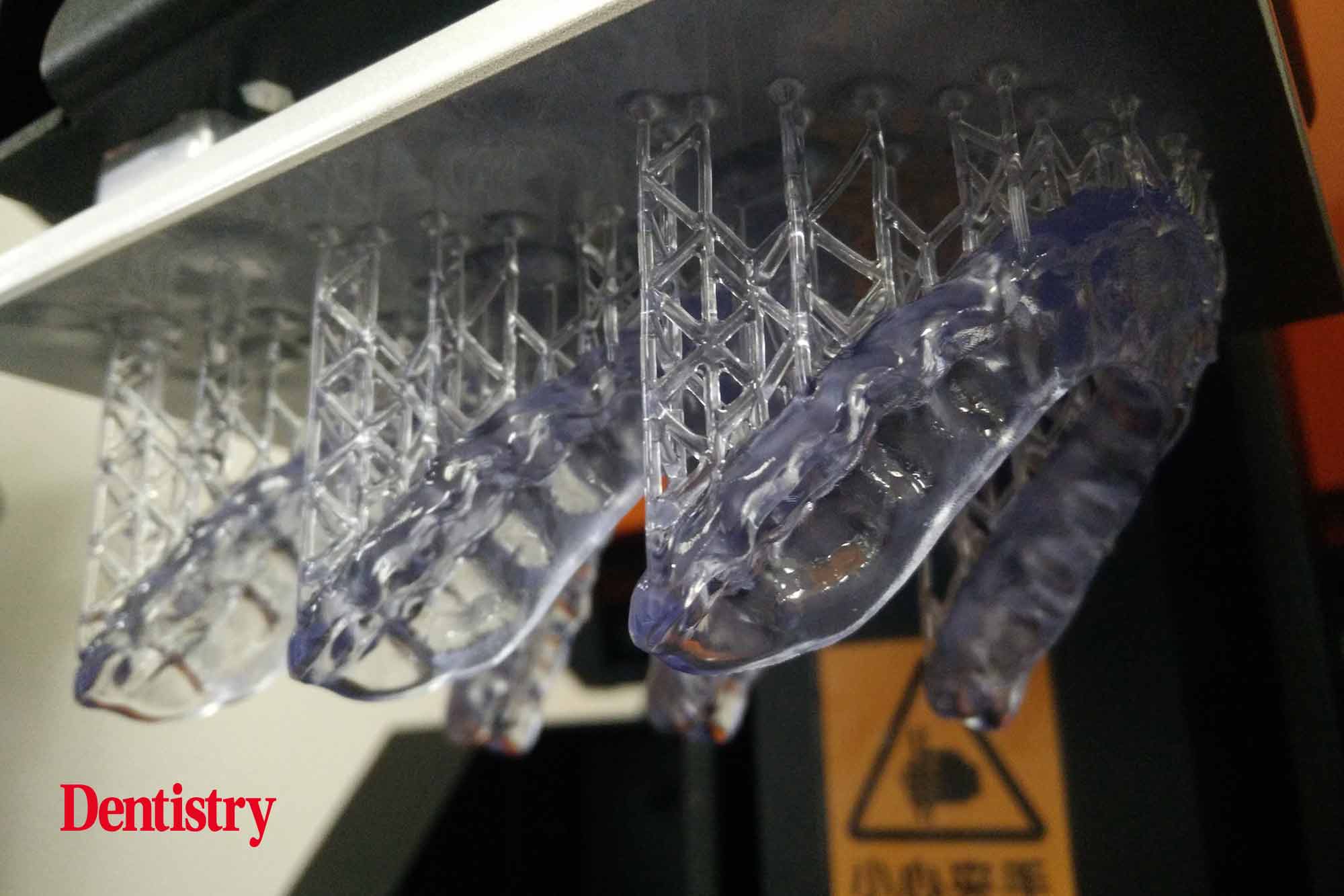 Andre Gaul RDT gives a step-by-step overview of the design and fabrication process of printed occlusal splints.