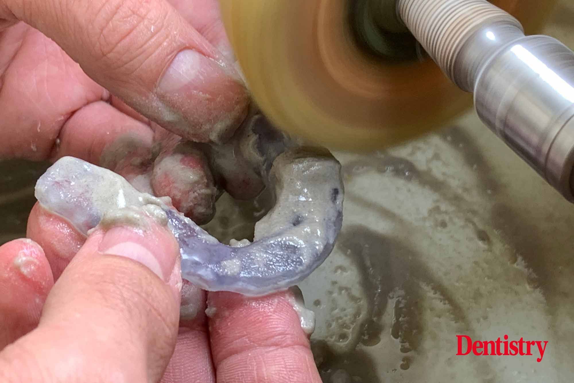 Andre Gaul RDT gives a step-by-step overview of the design and fabrication process of printed occlusal splints.