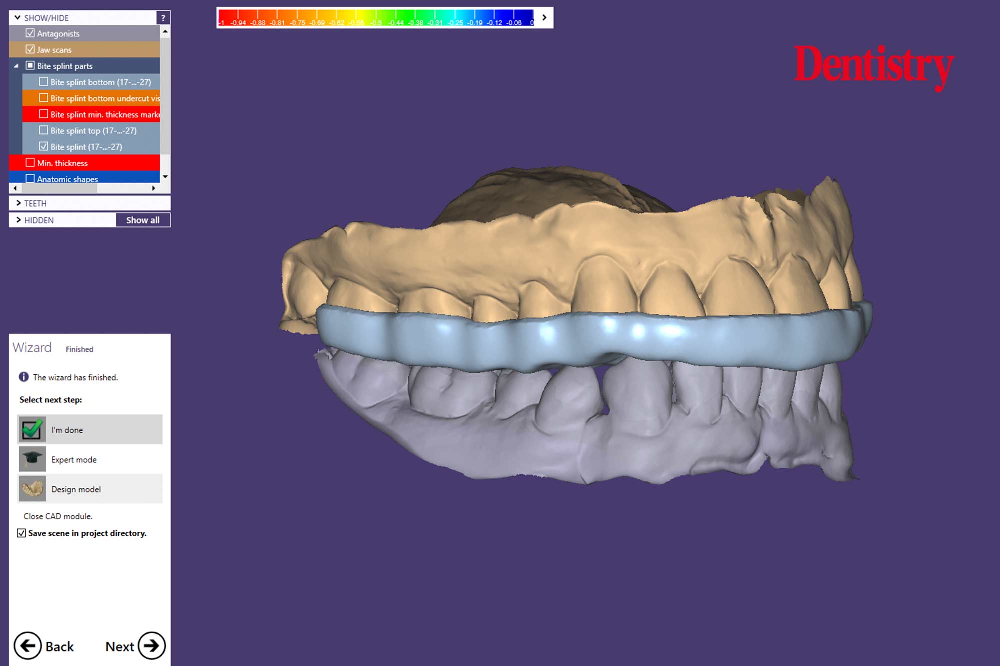 Andre Gaul RDT gives a step-by-step overview of the design and fabrication process of printed occlusal splints.