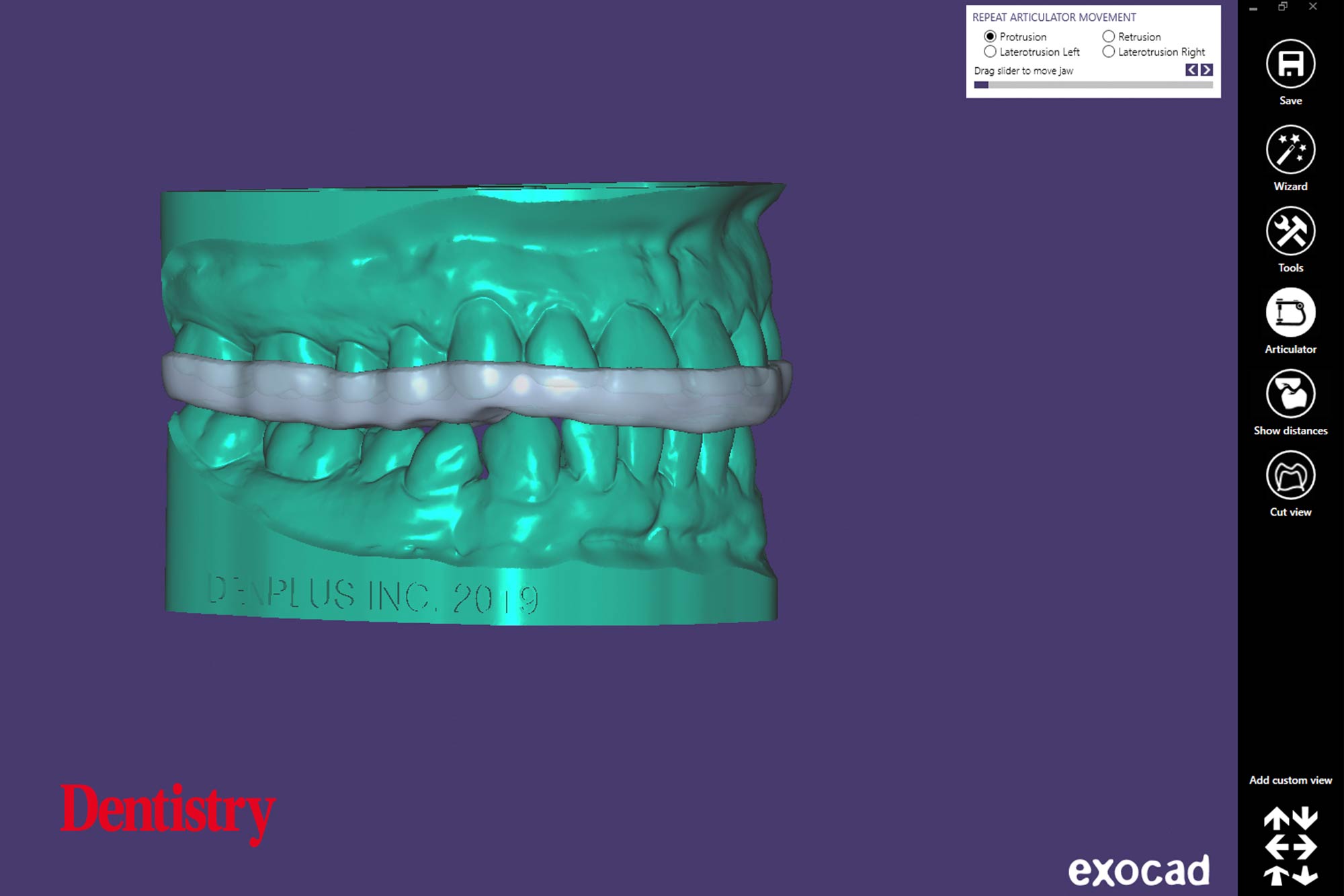 Andre Gaul RDT gives a step-by-step overview of the design and fabrication process of printed occlusal splints.