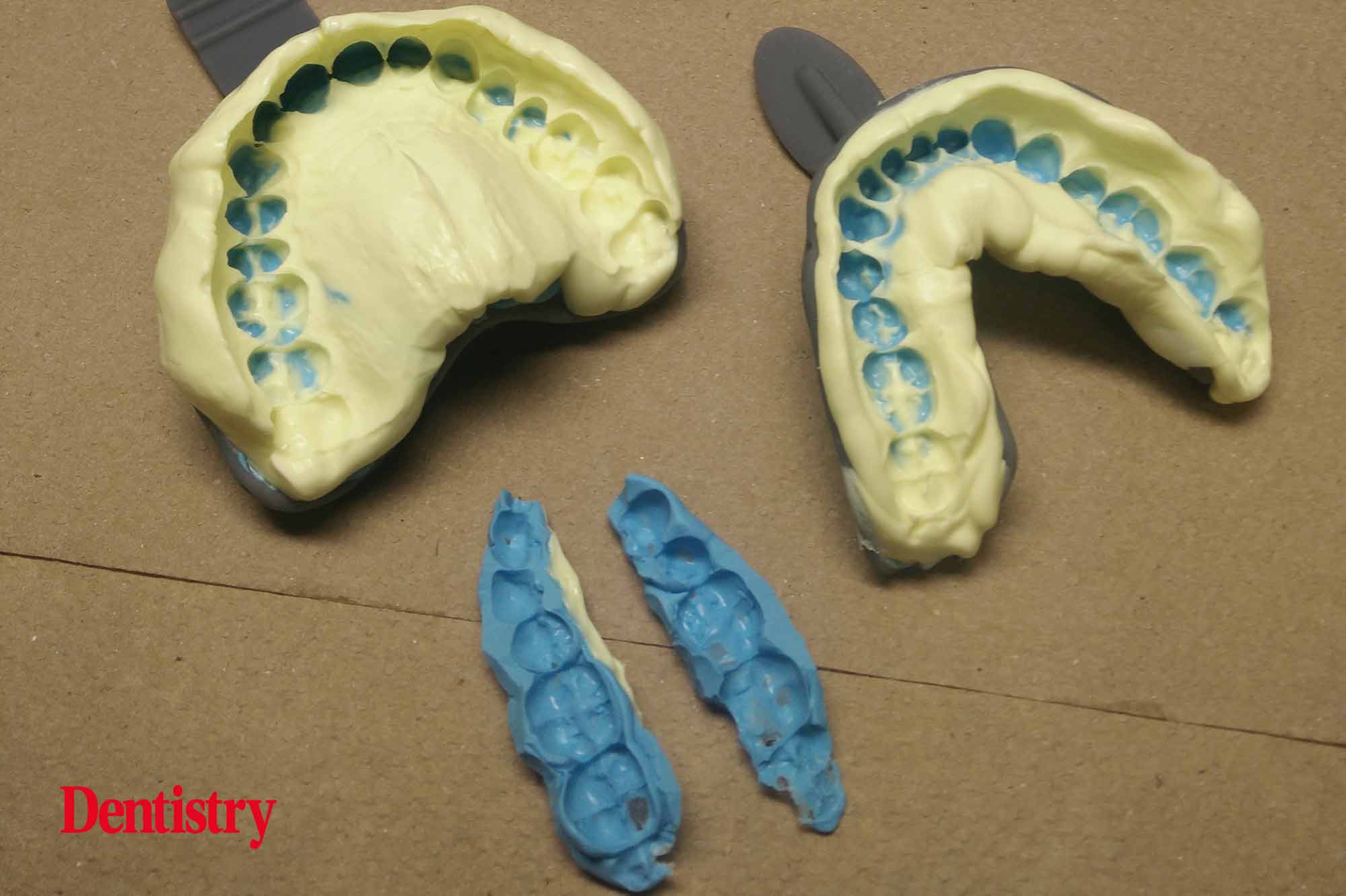 Andre Gaul RDT gives a step-by-step overview of the design and fabrication process of printed occlusal splints.