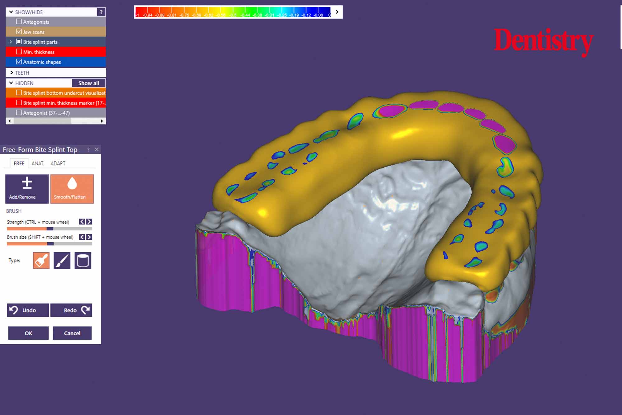 Andre Gaul RDT gives a step-by-step overview of the design and fabrication process of printed occlusal splints.