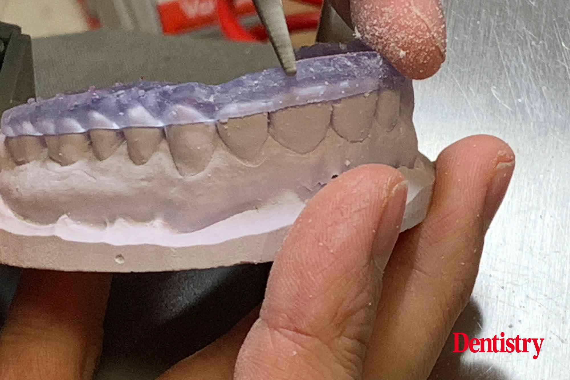 Andre Gaul RDT gives a step-by-step overview of the design and fabrication process of printed occlusal splints.