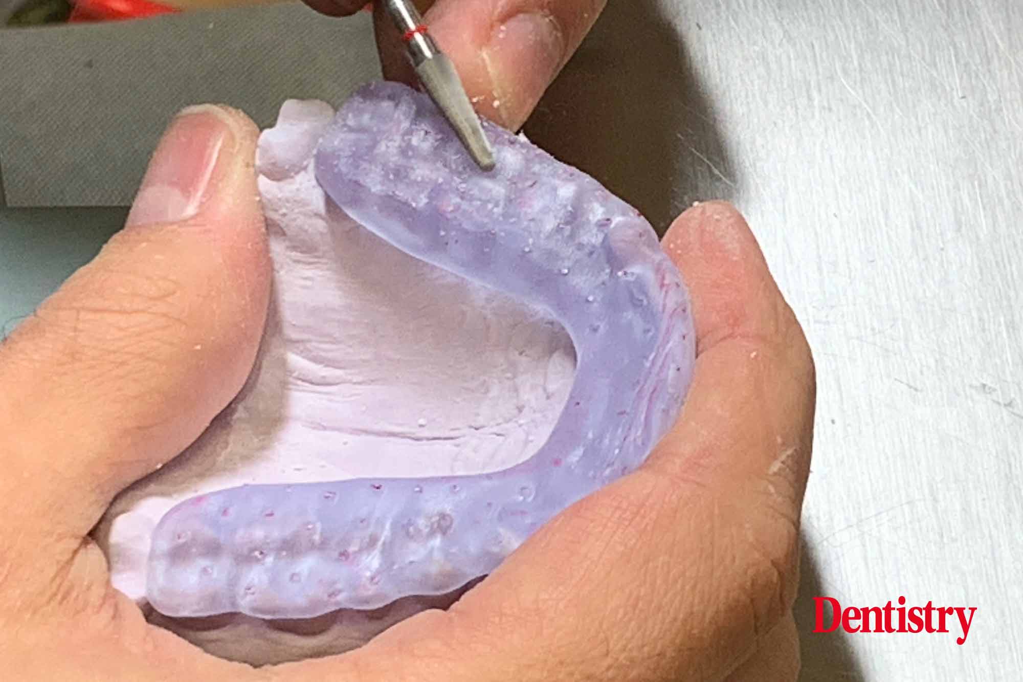 Andre Gaul RDT gives a step-by-step overview of the design and fabrication process of printed occlusal splints.
