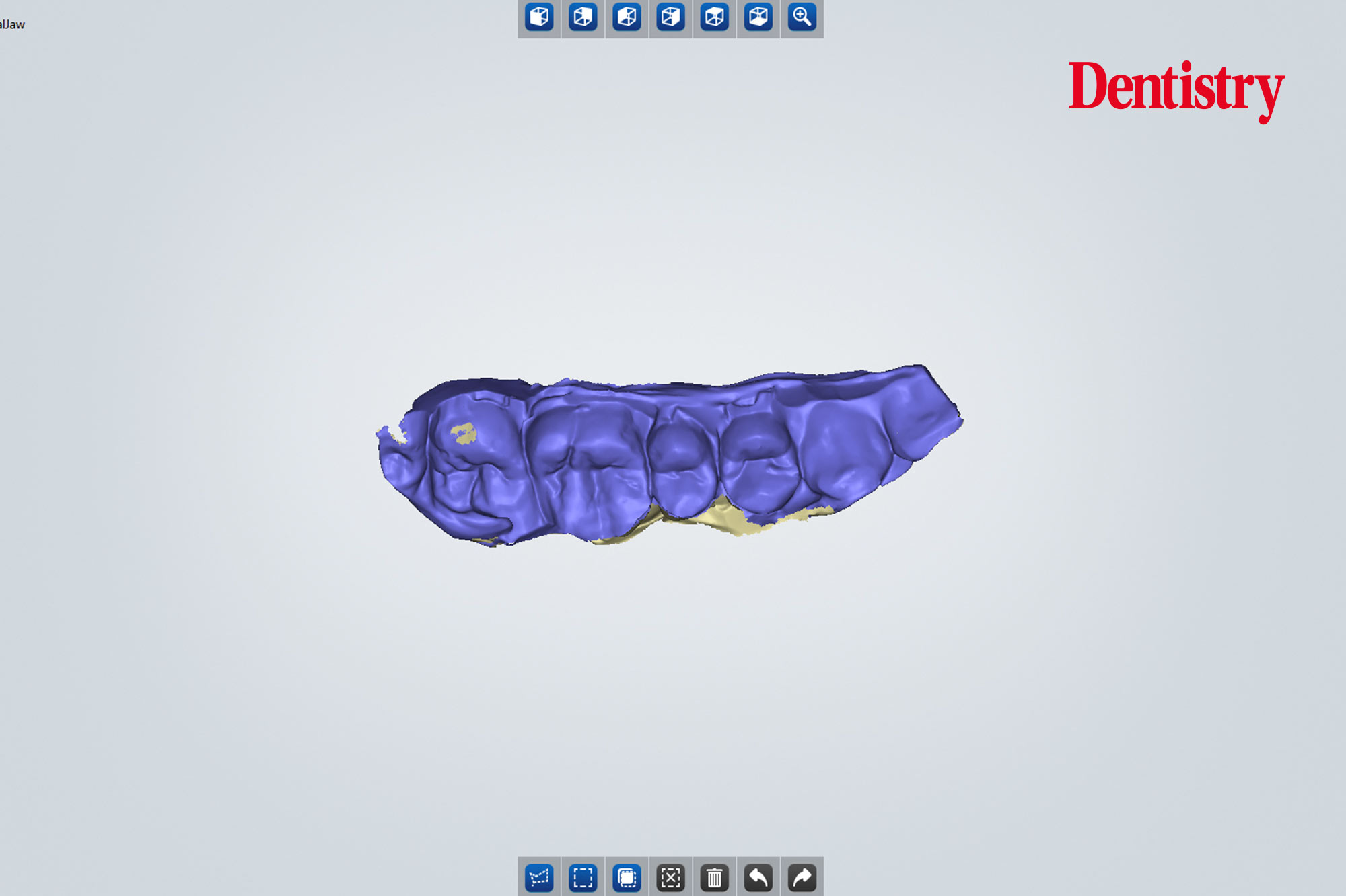 Andre Gaul RDT gives a step-by-step overview of the design and fabrication process of printed occlusal splints.