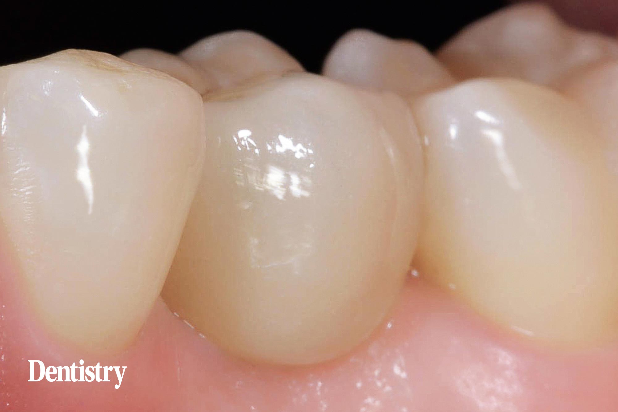 Mauro Fazioni and Andrea Lombardo discuss the importance of making implants with toothlike restoration materials and how you can do this.