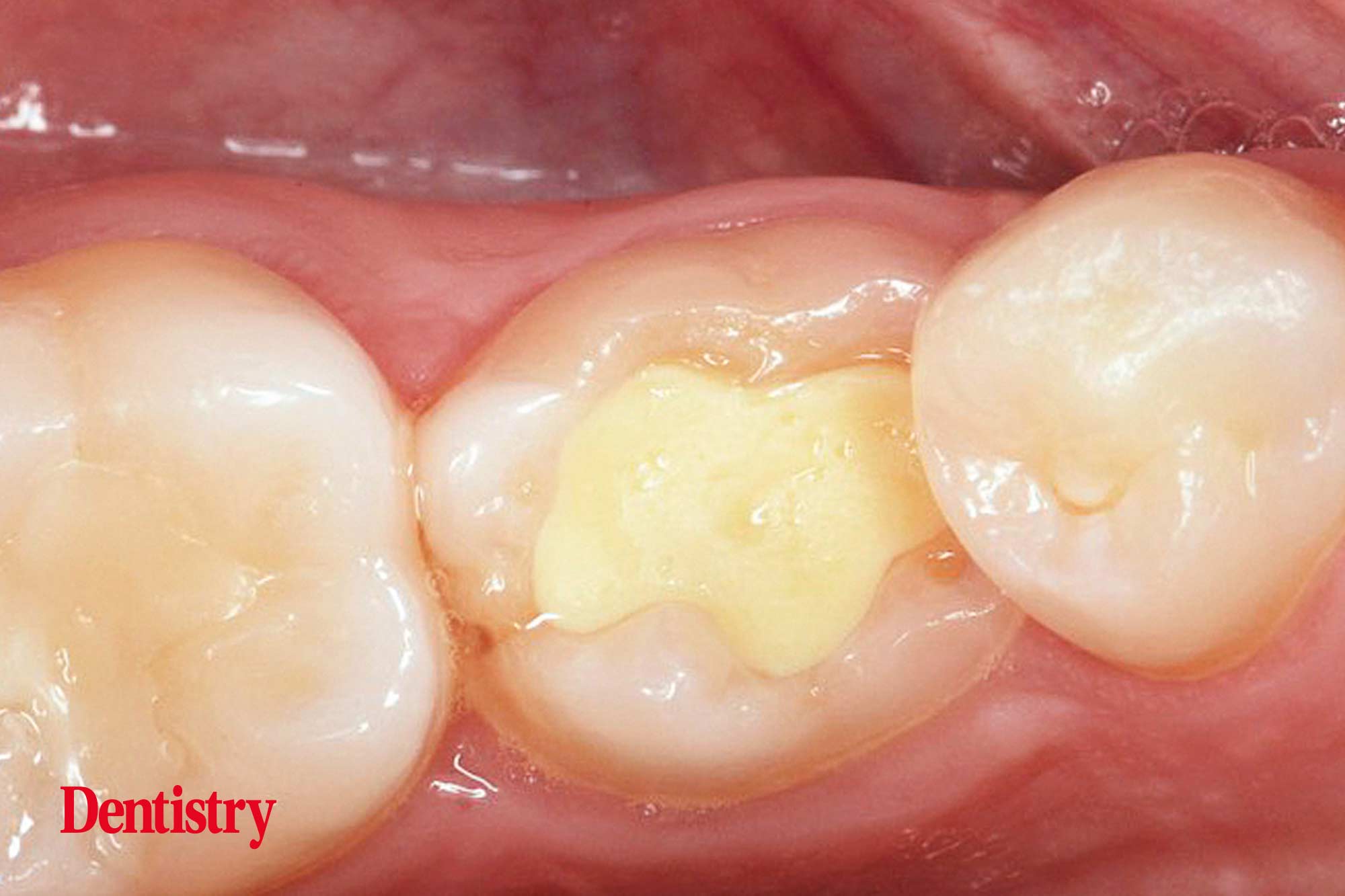 Mauro Fazioni and Andrea Lombardo discuss the importance of making implants with toothlike restoration materials and how you can do this.