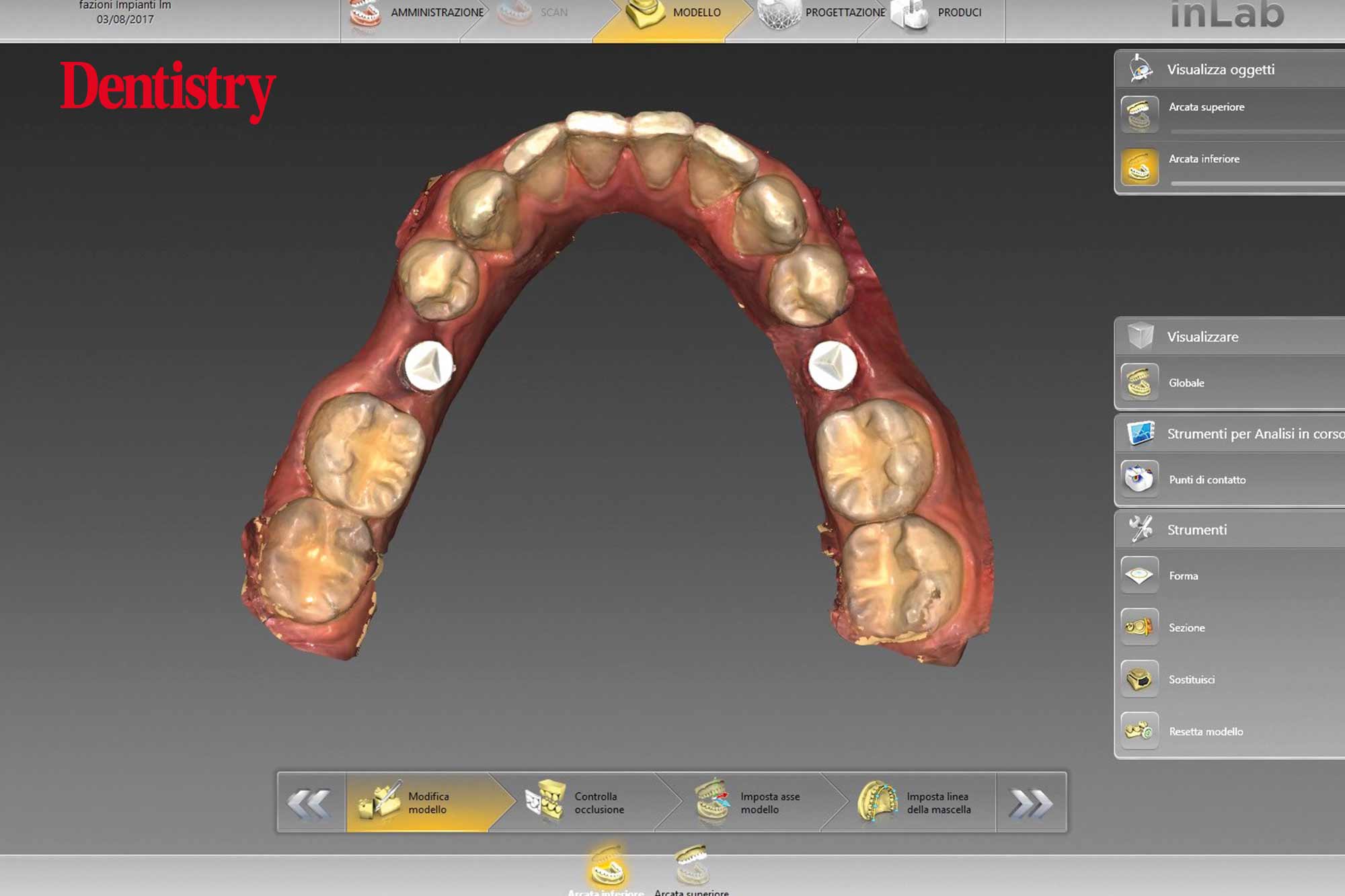 Mauro Fazioni and Andrea Lombardo discuss the importance of making implants with toothlike restoration materials and how you can do this.