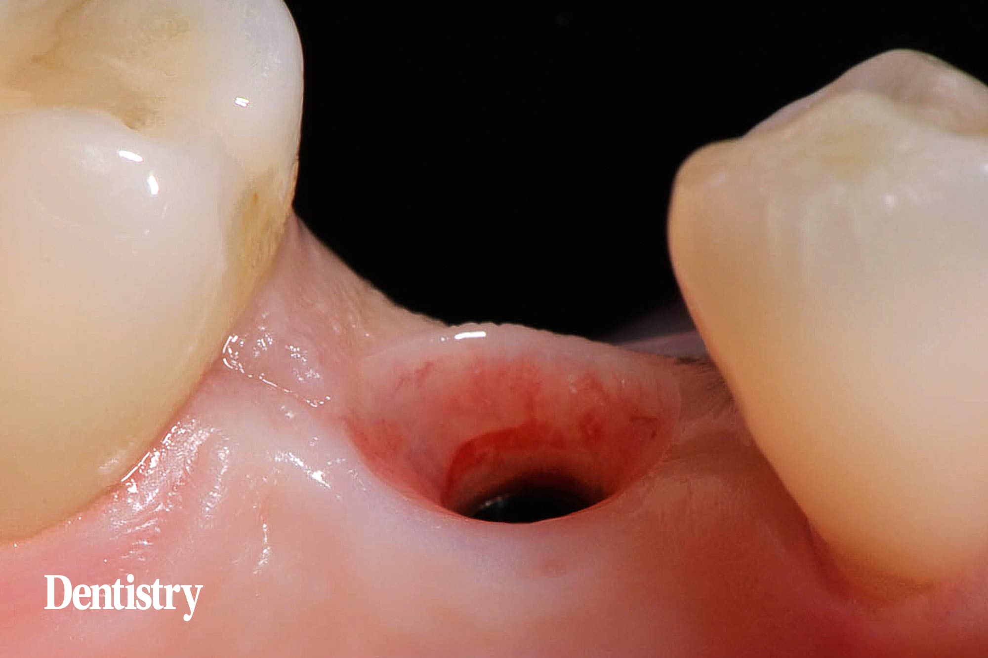 Mauro Fazioni and Andrea Lombardo discuss the importance of making implants with toothlike restoration materials and how you can do this.